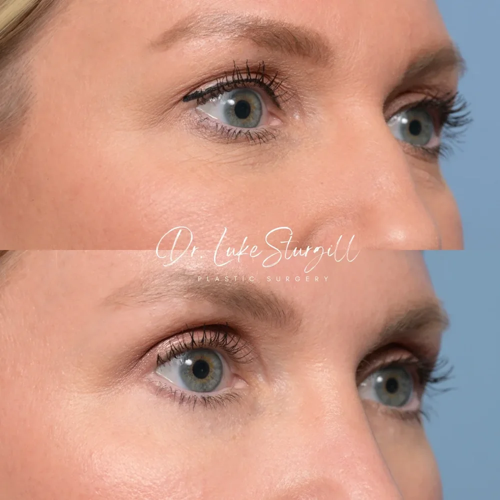 Eyelid surgery before and after — oblique view — male patient