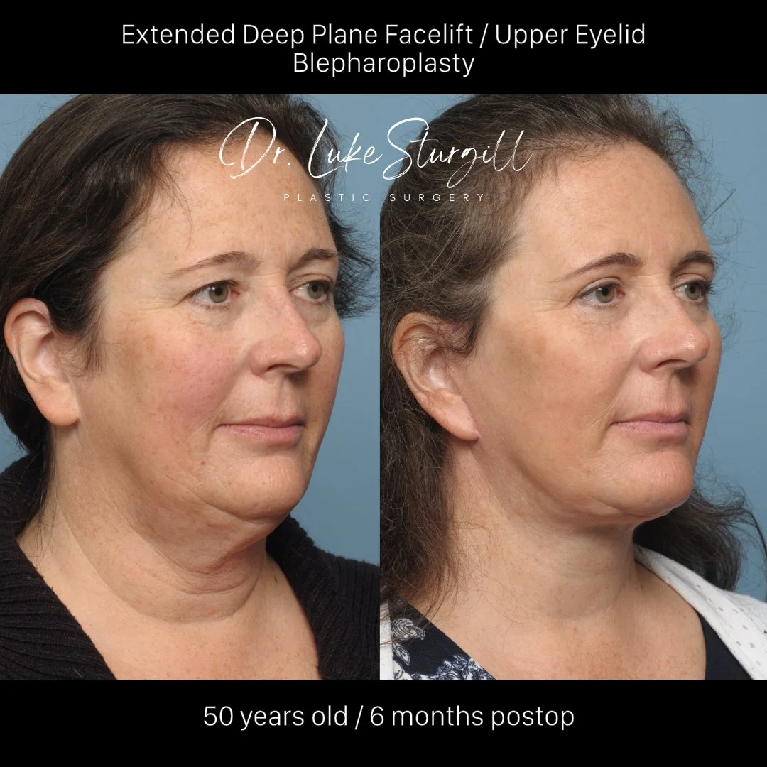 Deep plane facelift 6 months post-op — before and after — oblique view