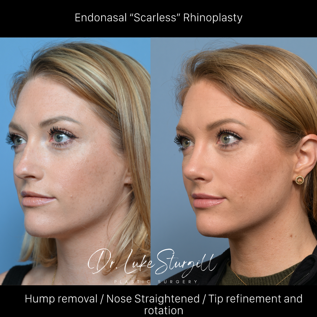 Rhinoplasty before and after — front view — female patient