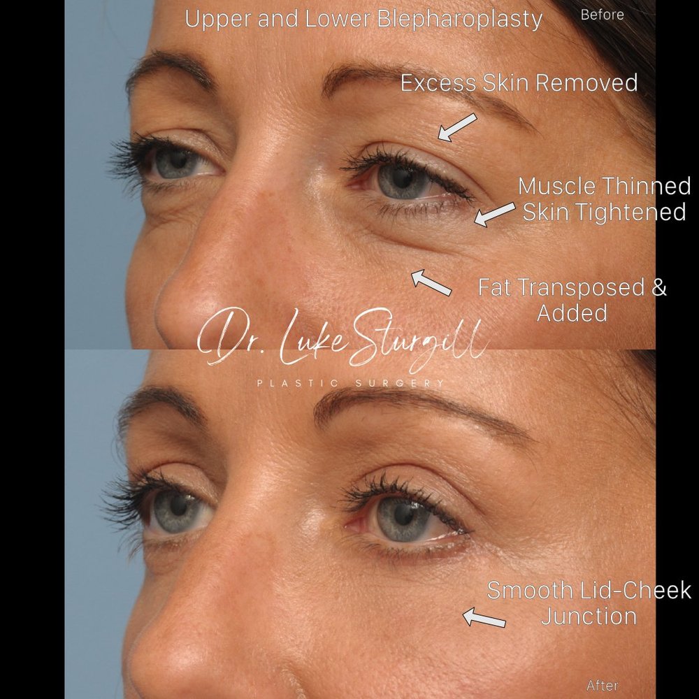 Upper and lower blepharoplasty before and after — annotated surgical result showing excess skin removal, muscle thinning, fat transposition, and smooth lid-cheek junction