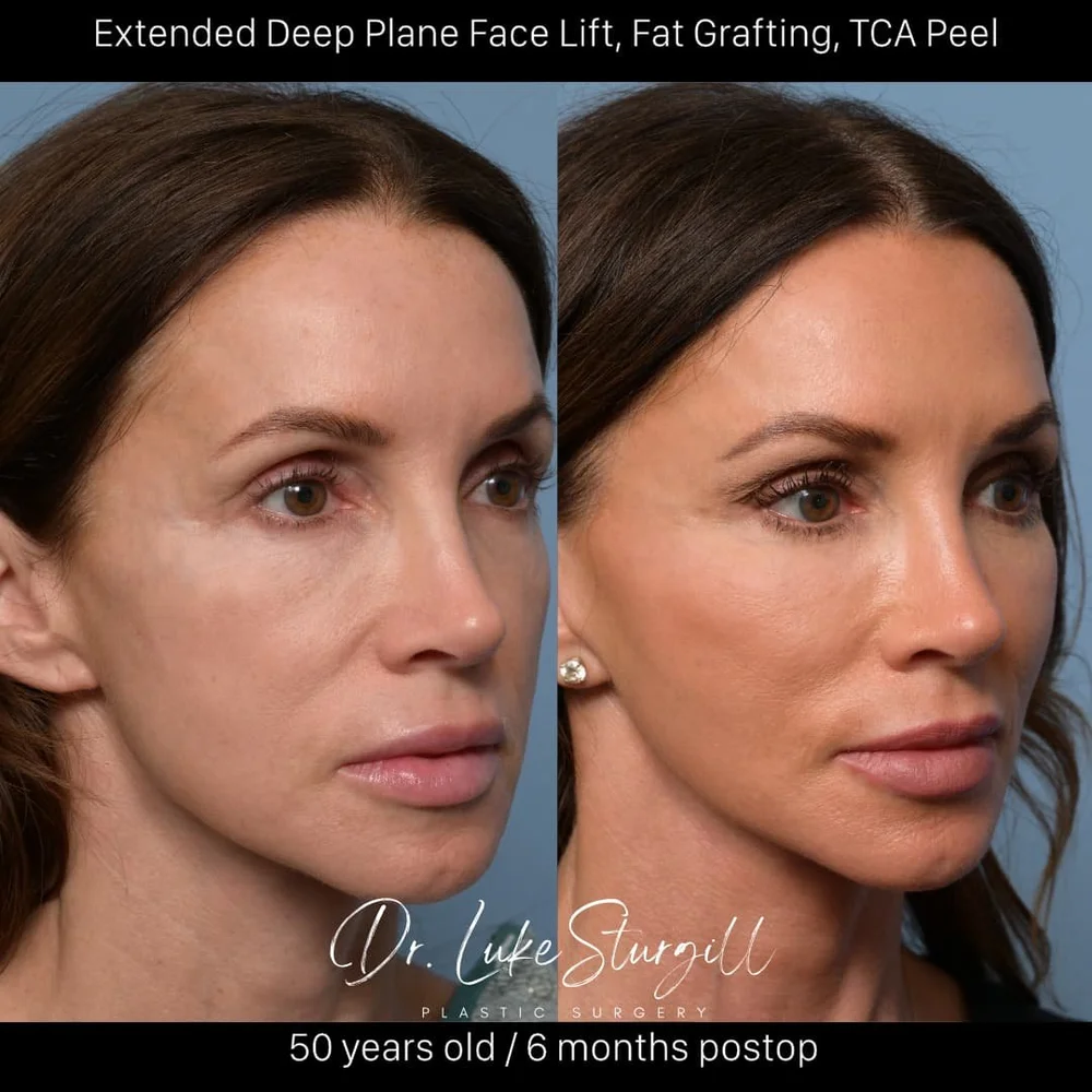 Deep plane facelift before and after — oblique view — female patient