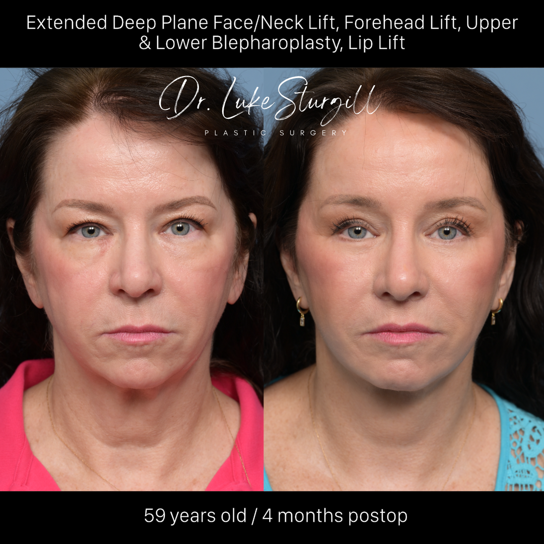 Deep plane facelift before and after — oblique view — female patient