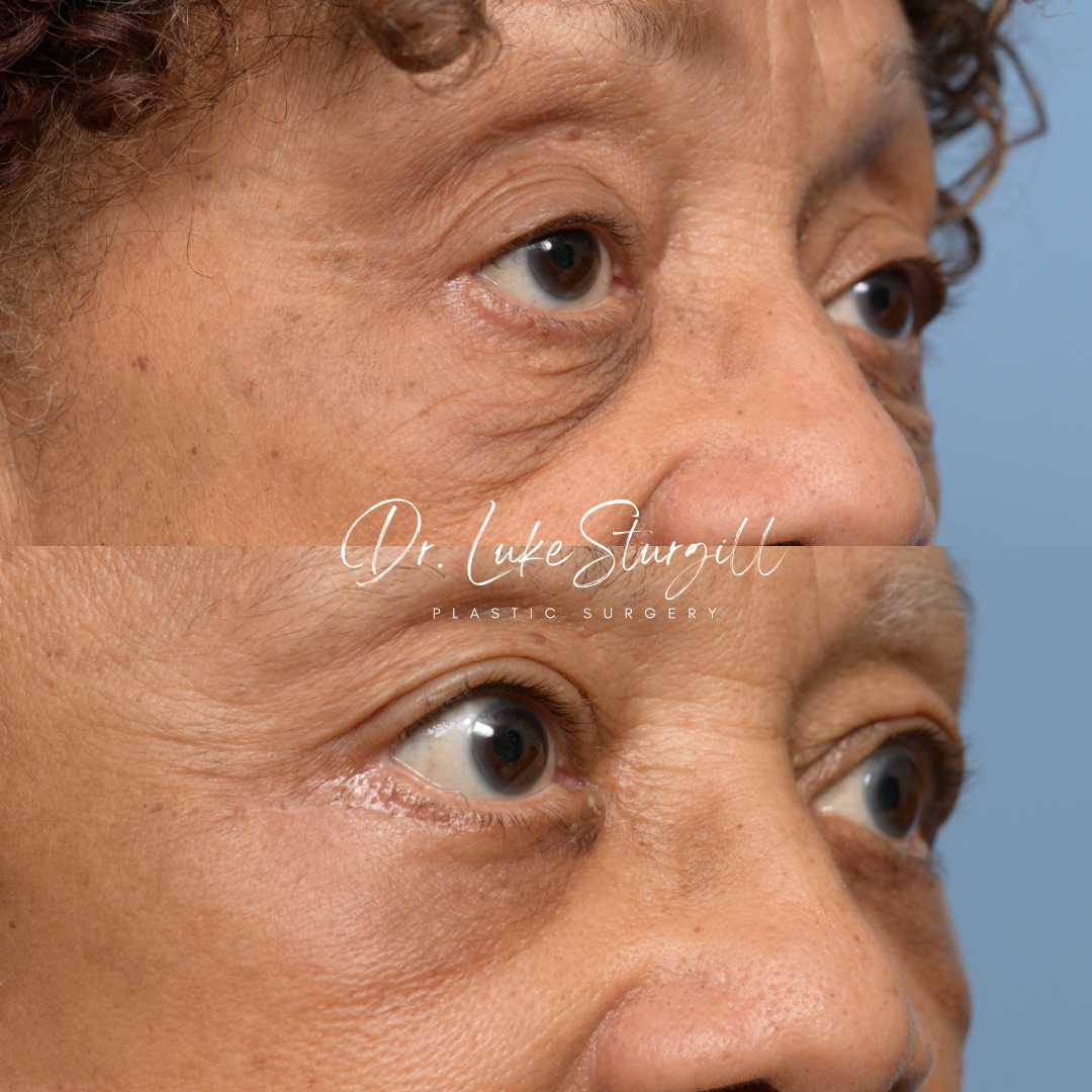 Eyelid surgery before and after — front view — female patient