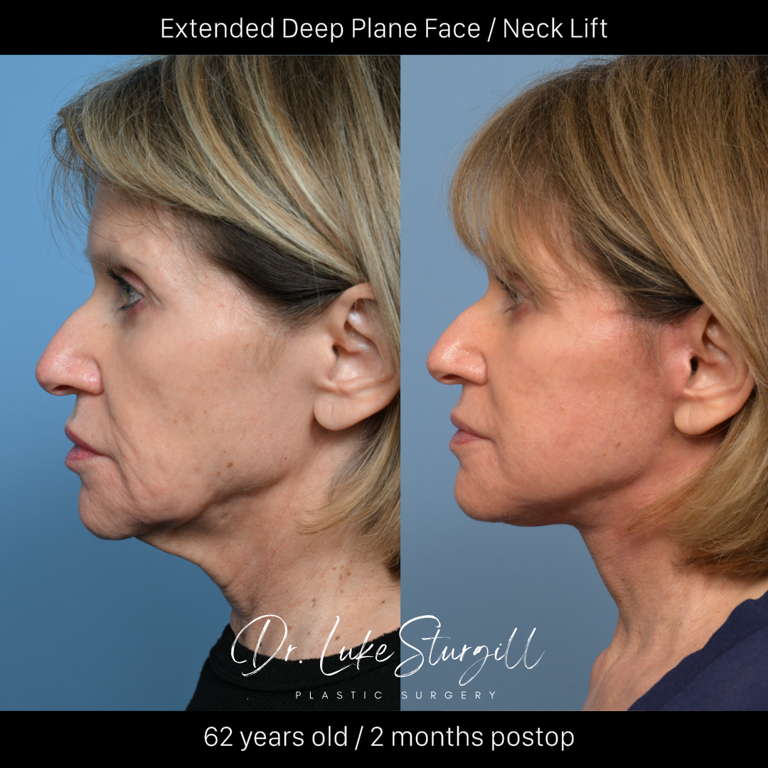 Deep plane facelift before and after — front view — female patient