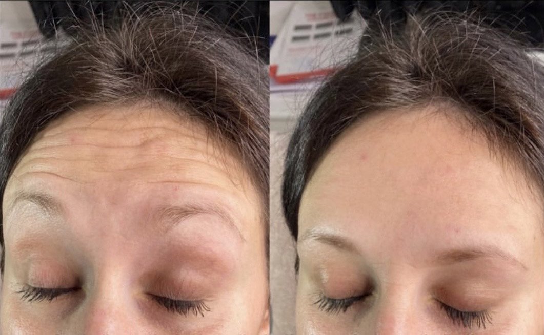 Anti-Wrinkle Treatment (Forehead).jpg