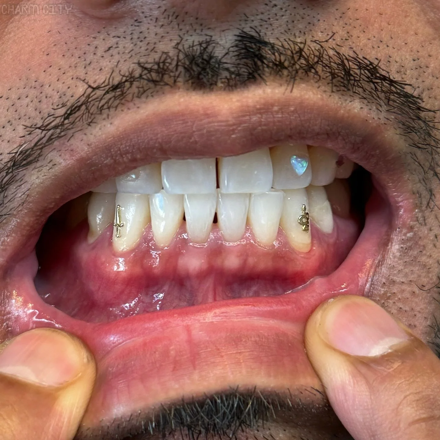 I spy with my little eye 3 TOOTH GEMS 🦷✨

Bottom canines looking baller with two 18k yellow gold (Dagger &amp; Snake) gems 🗡️🐍 plus one blue opal heart on top.💙

#sftoothgems #sanfranciscotoothgems #goldtoothgems #snaketoothgem #daggertoothgem #o