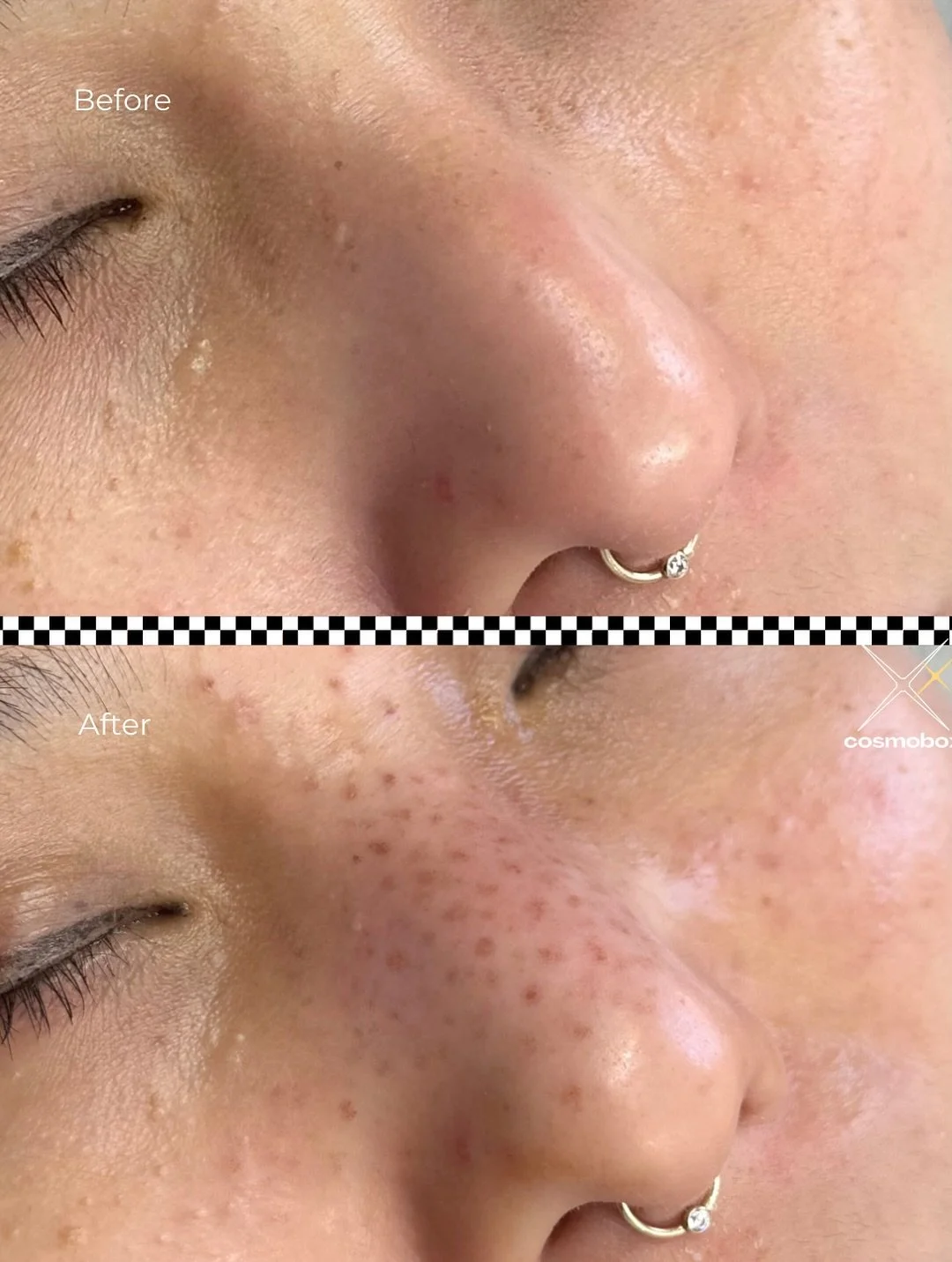 Hand-Poked Freckles
These semi-permanent freckles are created with a precise, hand-poked technique for a natural, sun-kissed look.

👉 What to Expect:
&bull; Freckles appear rosy and more defined at first &mdash; this softens as they heal.
&bull; Hea