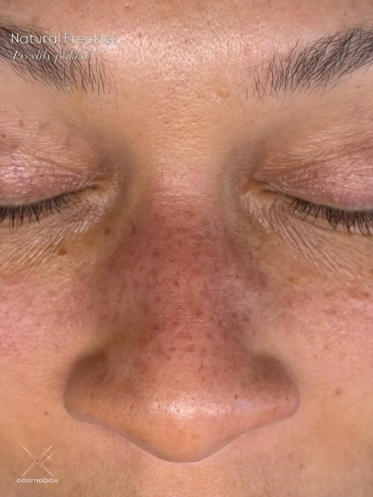 Perfectly natural... and we're just getting started. 🤌
(Swipe to see her nose before 👉)

This perfectly freckled nose is freshly poked at the 1st session - and while they look beautifully natural and skin-like, she's ready to go a little bolder at 