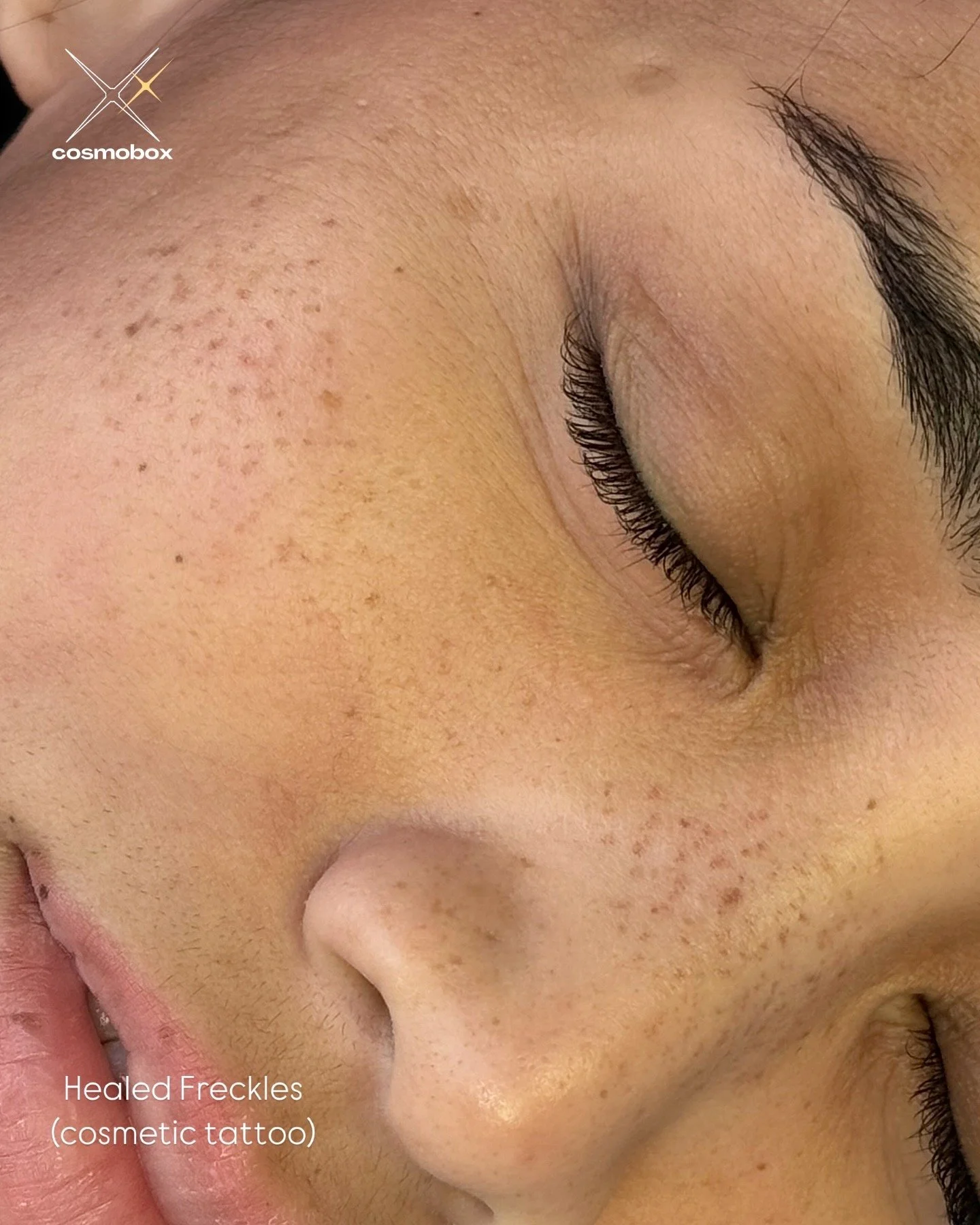 Light freckle pattern, healed