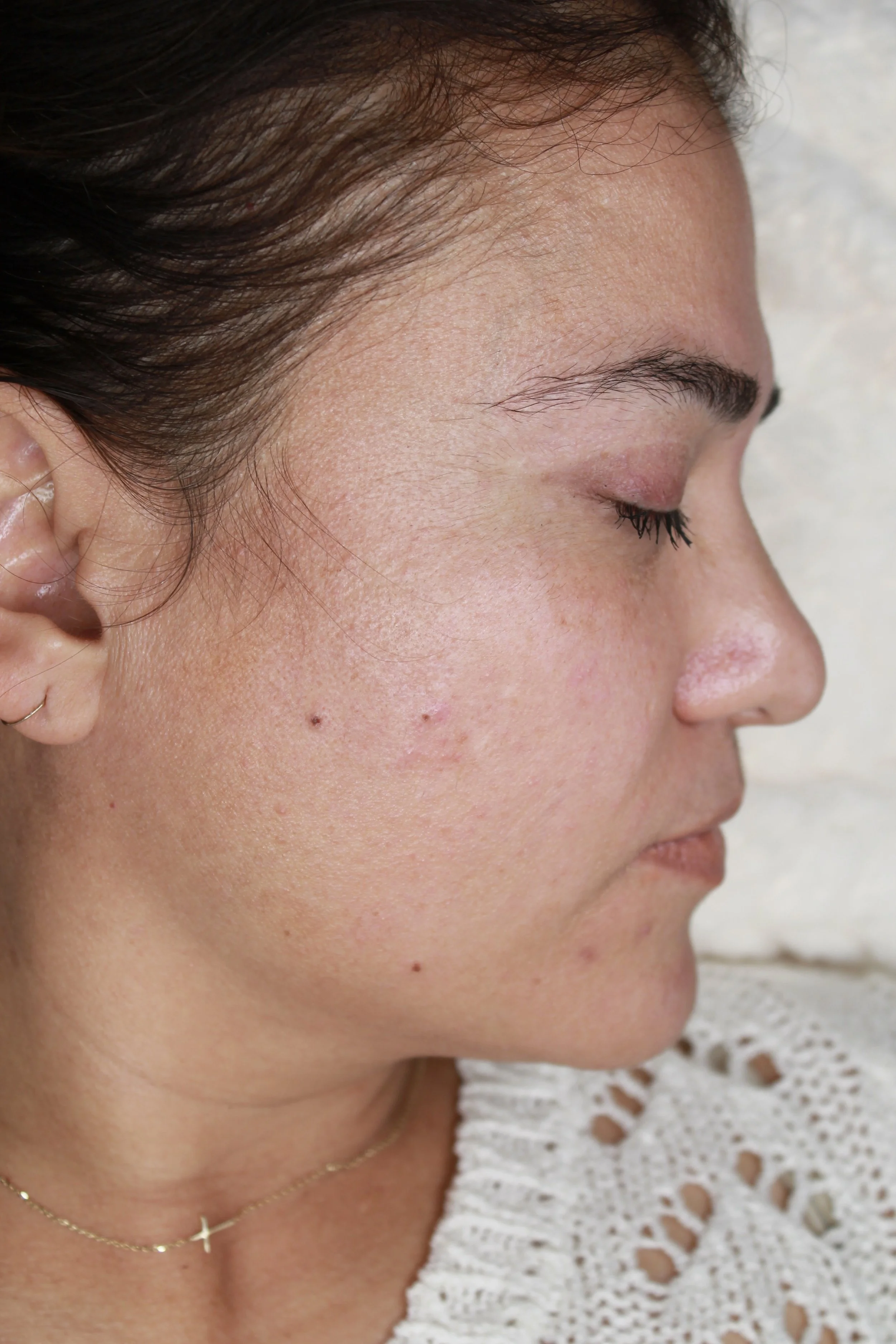 Healed beauty marks