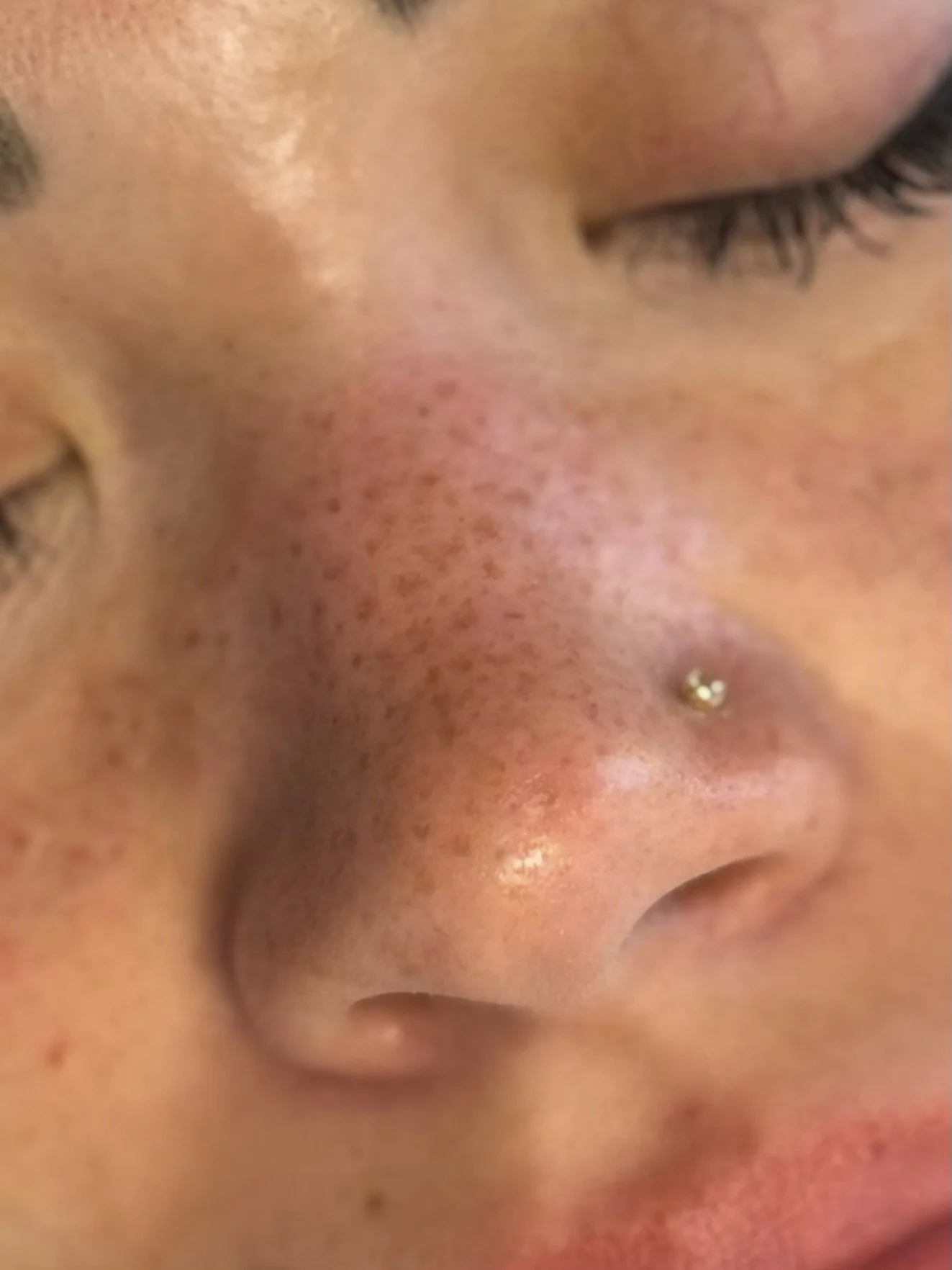 Natural freckles, healed.