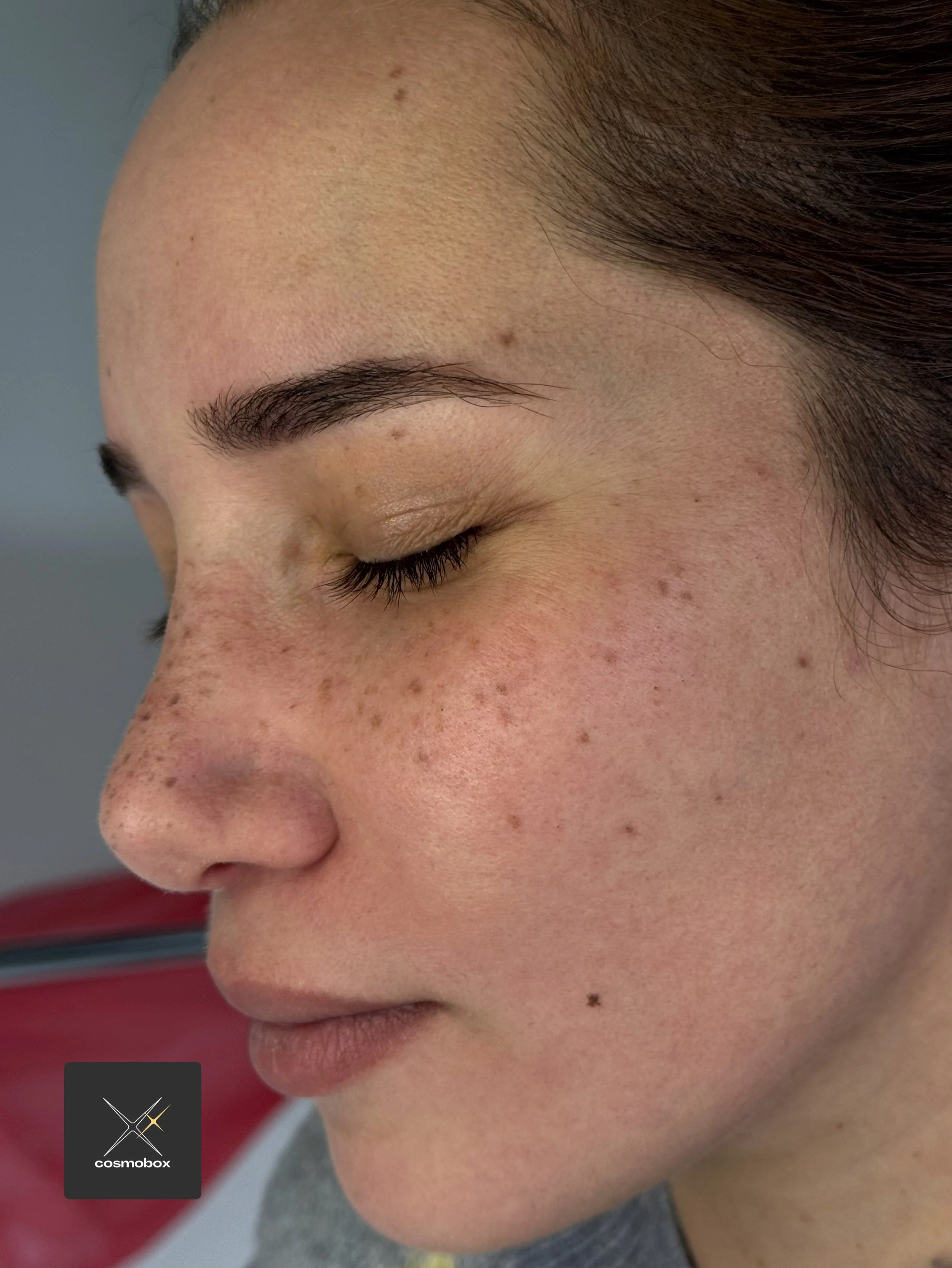 Healed freckles and beauty marks.
