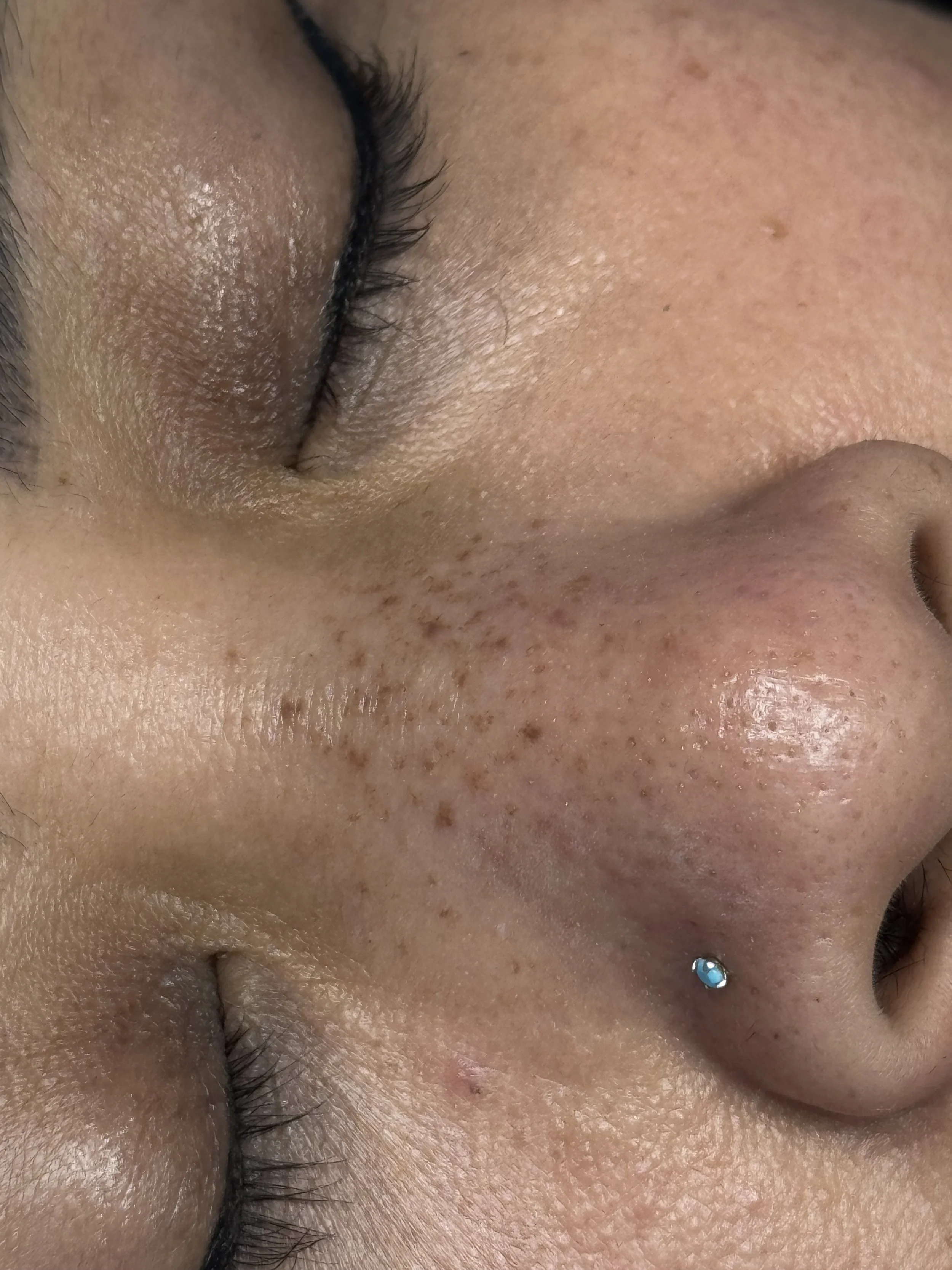 Healed freckled nose (1 session)