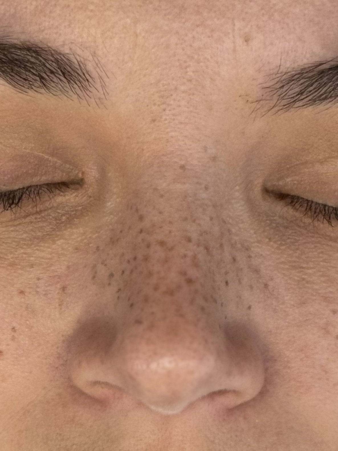 A mix of healed freckles with mapped freckles (black dots) at her freckle perfecting session.