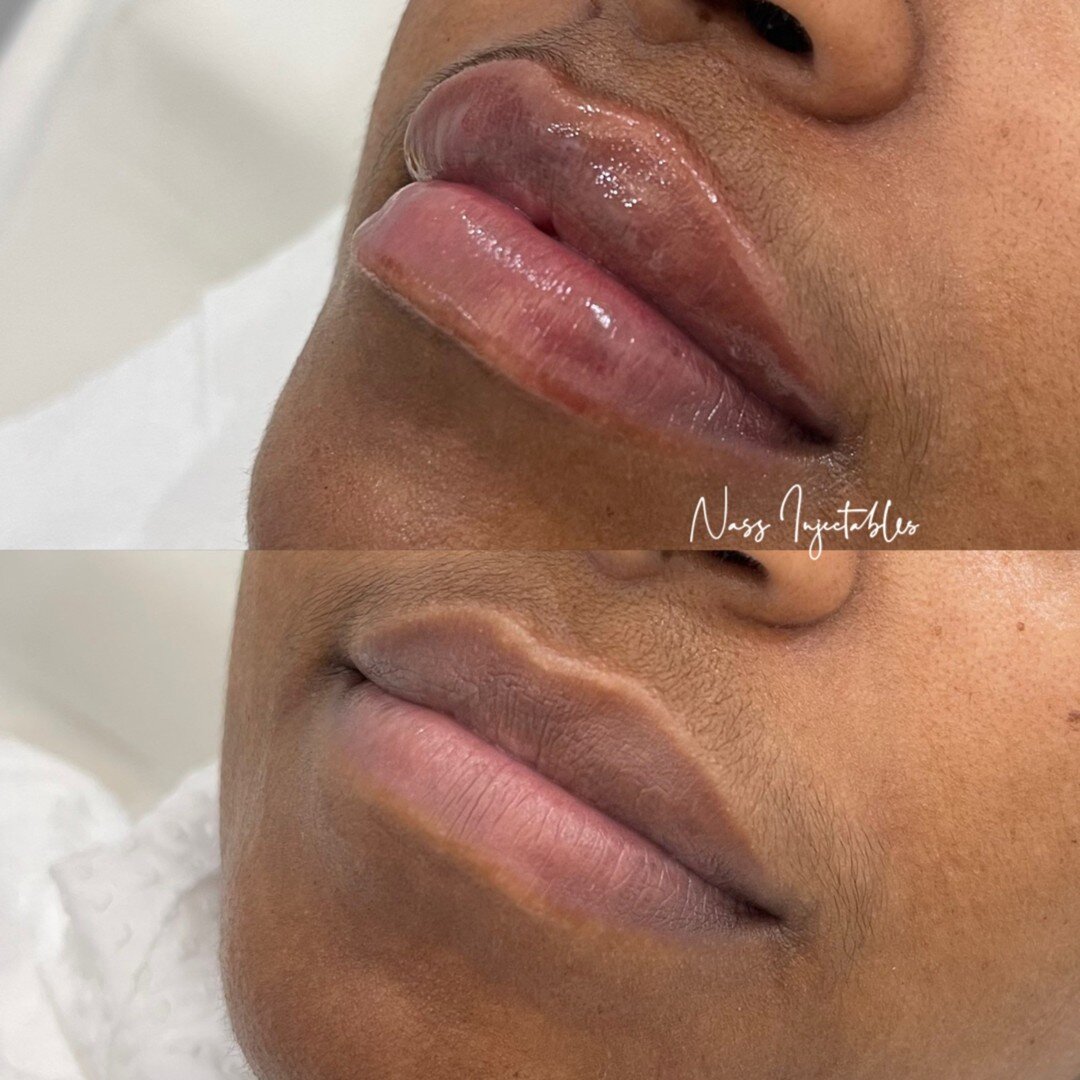 Soft, natural enhancements actually give me life 🥰

Did you know, that not only does lip filler give our lips a smooth, plump look and feel but it also helps to improve lip hydration too? Yes please 💧

If lip filler is something you've thought abou