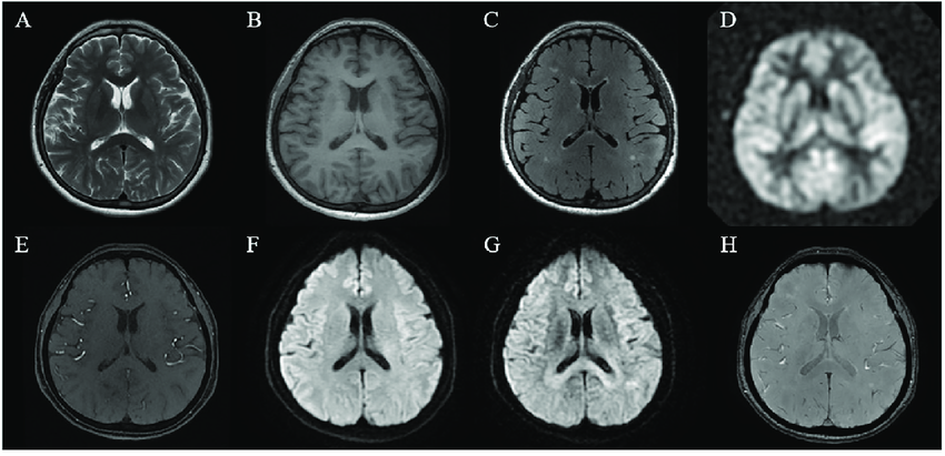 MRI+Image+segmentation+DDD