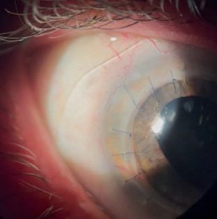 How the Custom Stable Elite Rewrote the Script on Ocular Surface Disease and Corneal Irregularities