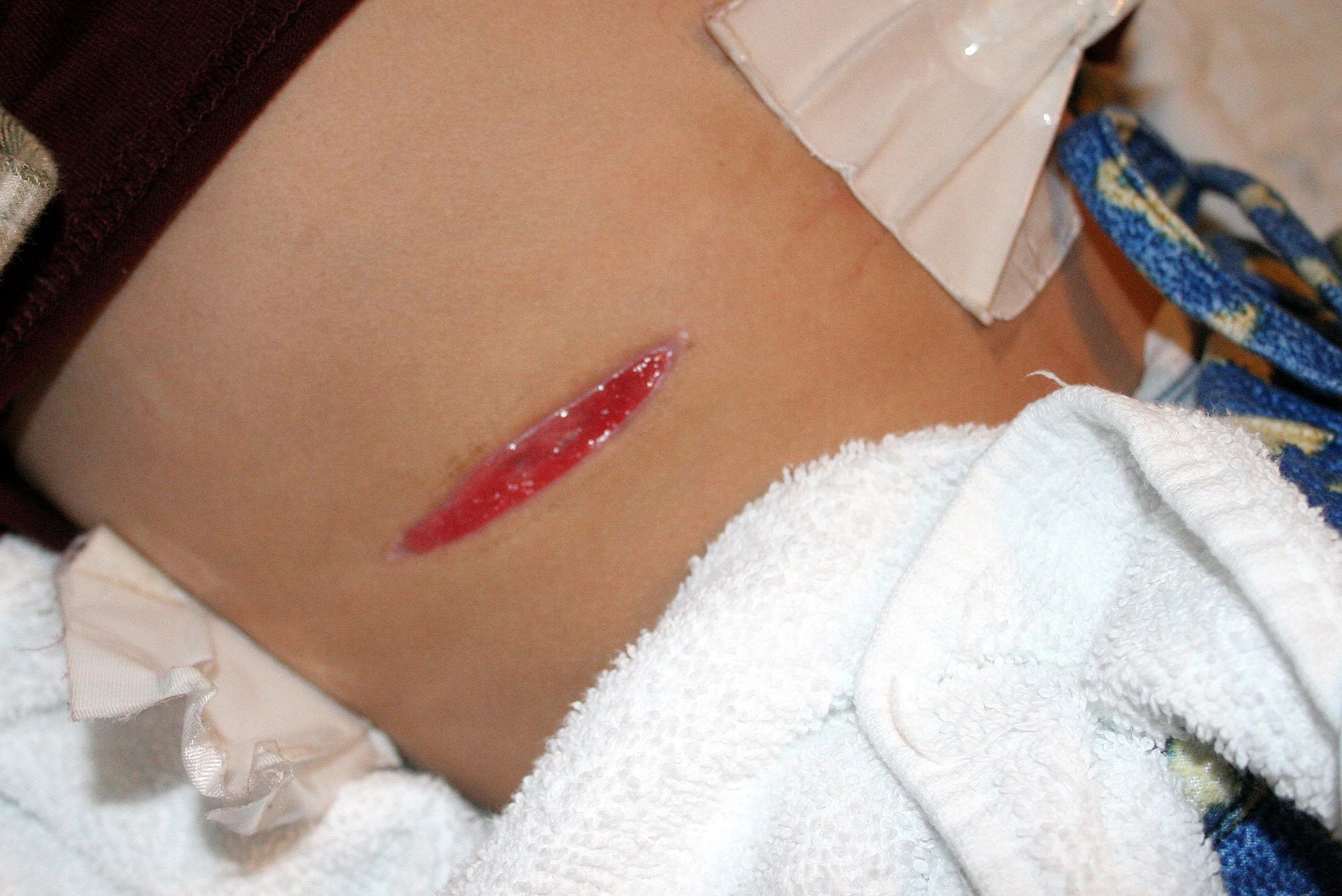 2008-1-25 COKIES WOUND HEALING.jpg
