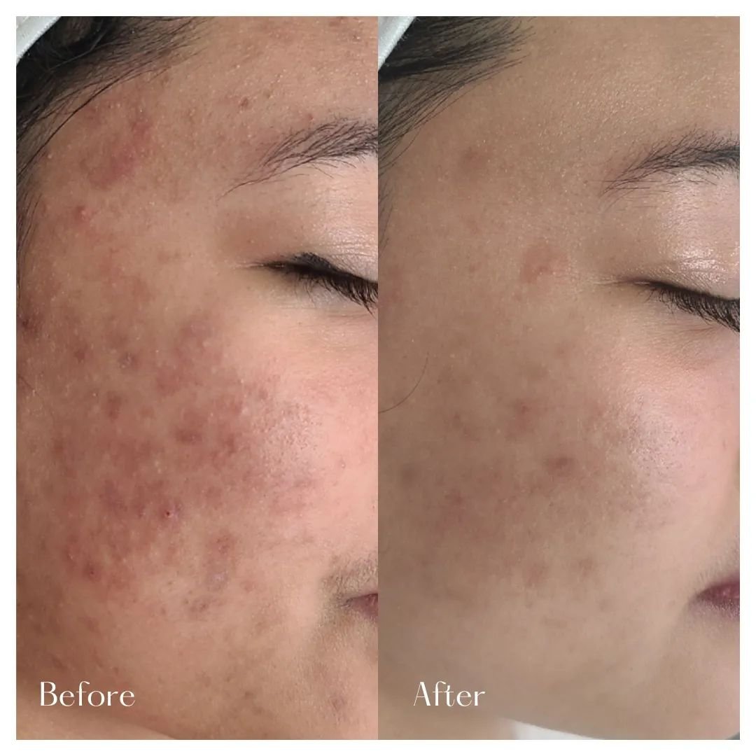 From acne-prone to acne-free! ✨ 

Witness the transformative power of our acne treatment with stunning before-and-after results. Say goodbye to blemishes and hello to radiant, clear skin! 

Book your session now and let's unveil your glow-up together