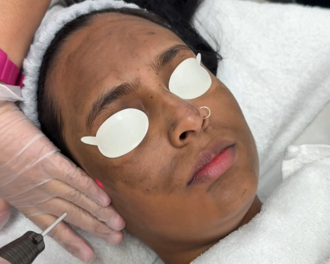 Struggling with Dull Skin? Here’s How the Hollywood Laser Peel Brings Back Your Radiance