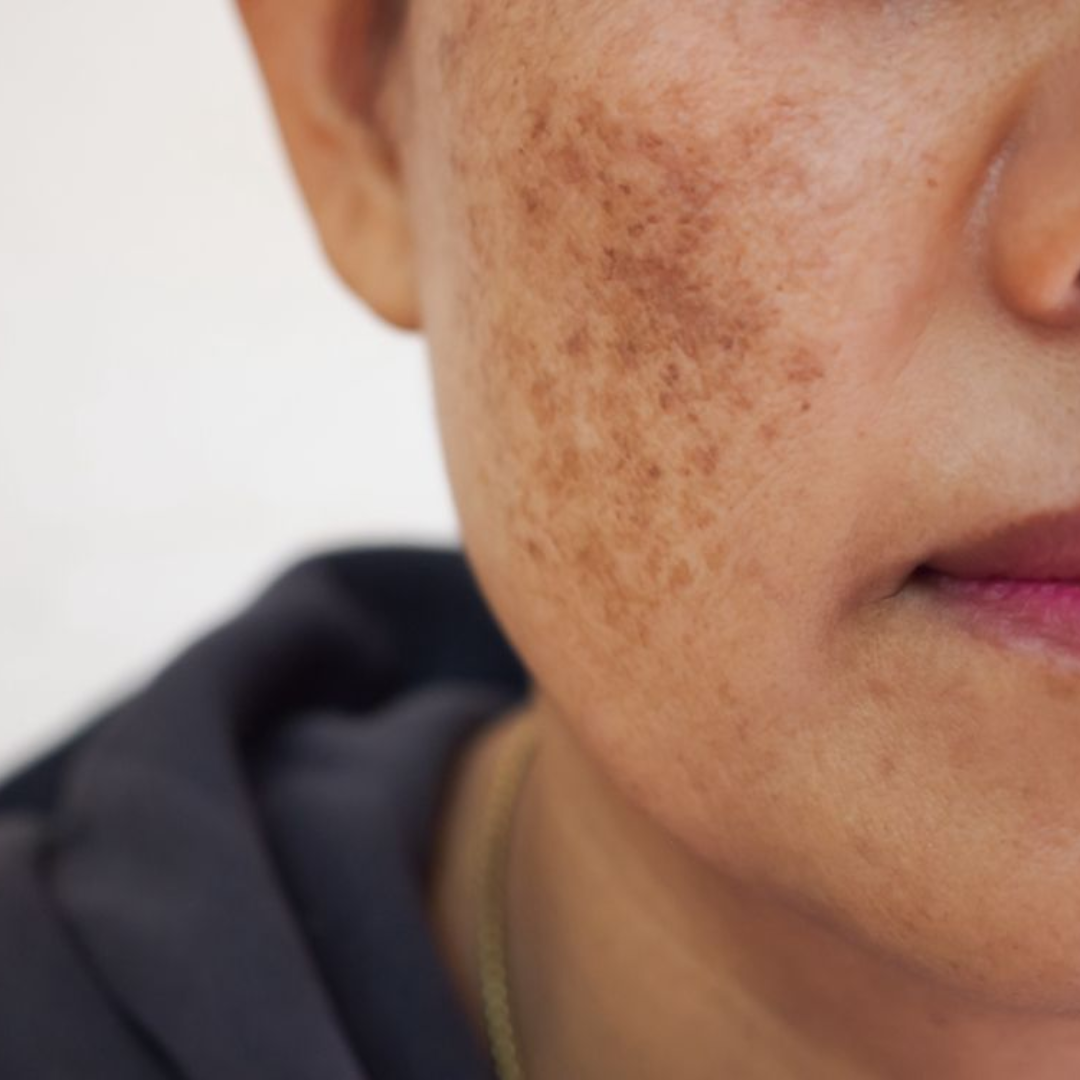 Melasma vs. Hyperpigmentation: What’s the Difference?