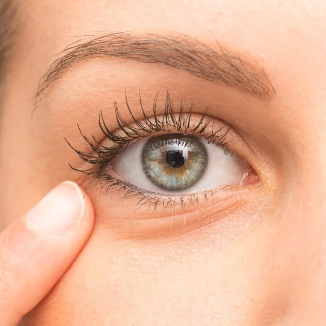 How NCTF Can Help With Dark Circles and Eye Bags