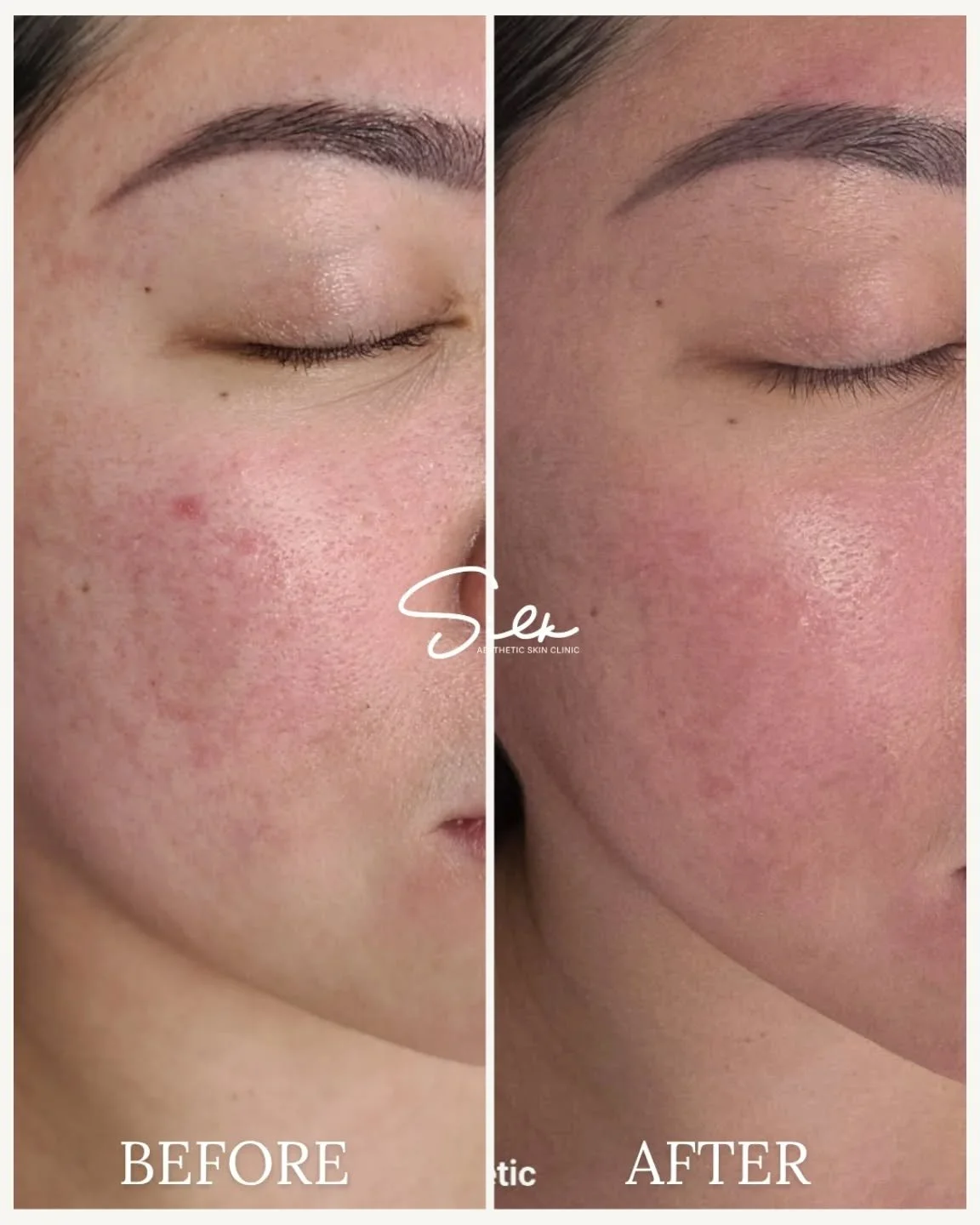 Fade the spots, not your confidence. ✨ 
Hyperpigmentation, redness, and uneven texture can make your skin look tired, but the right treatment can bring back your natural glow. 
At Silk Aesthetic Skin Clinic, we target stubborn pigmentation and skin