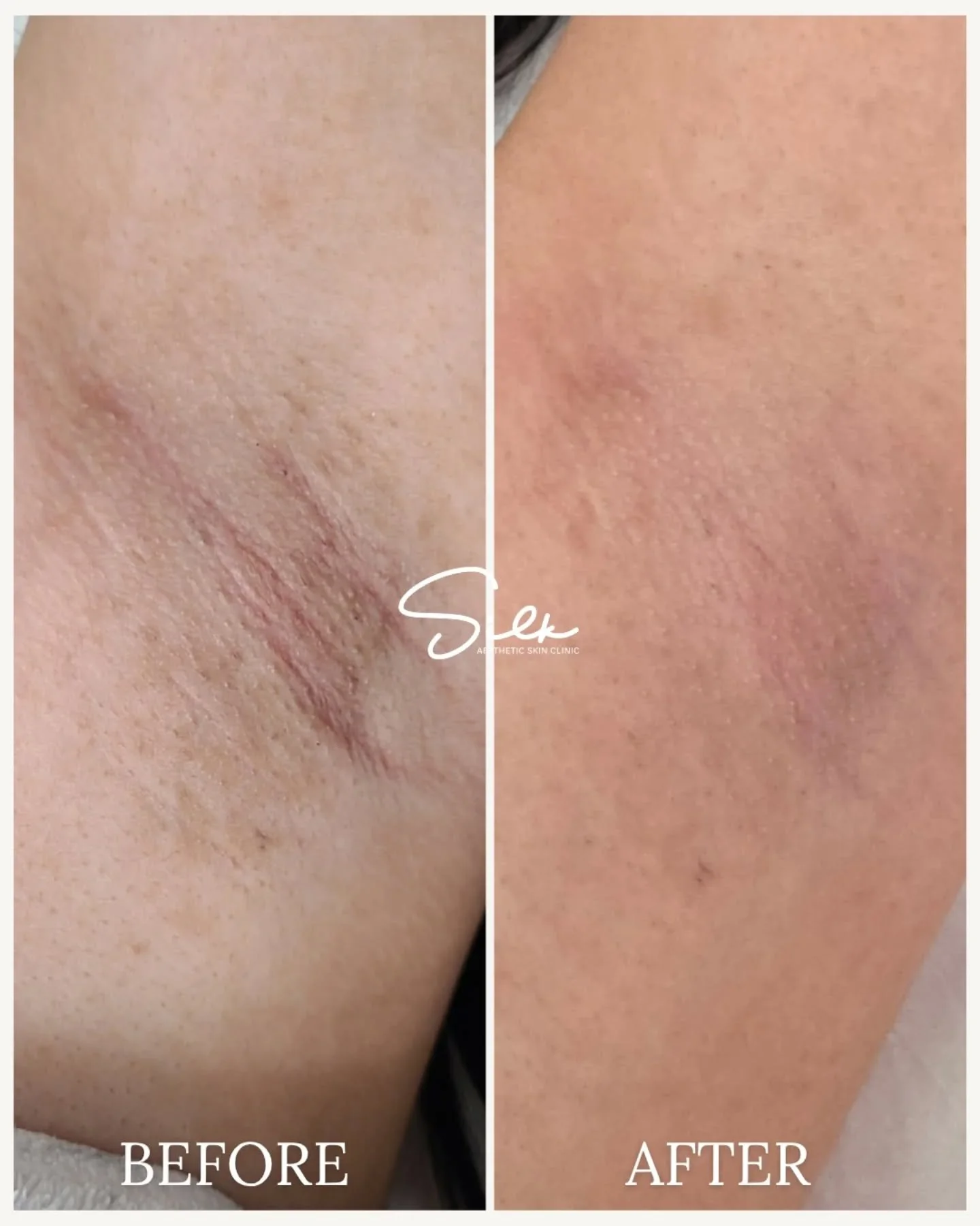 Confidence looks even better with brighter underarms 💫 

When you treat your skin with care, the results speak for themselves. Our Underarm Skin Lightening Treatment is designed to gently fade dark spots, smooth texture, and restore your skin&rsquo;