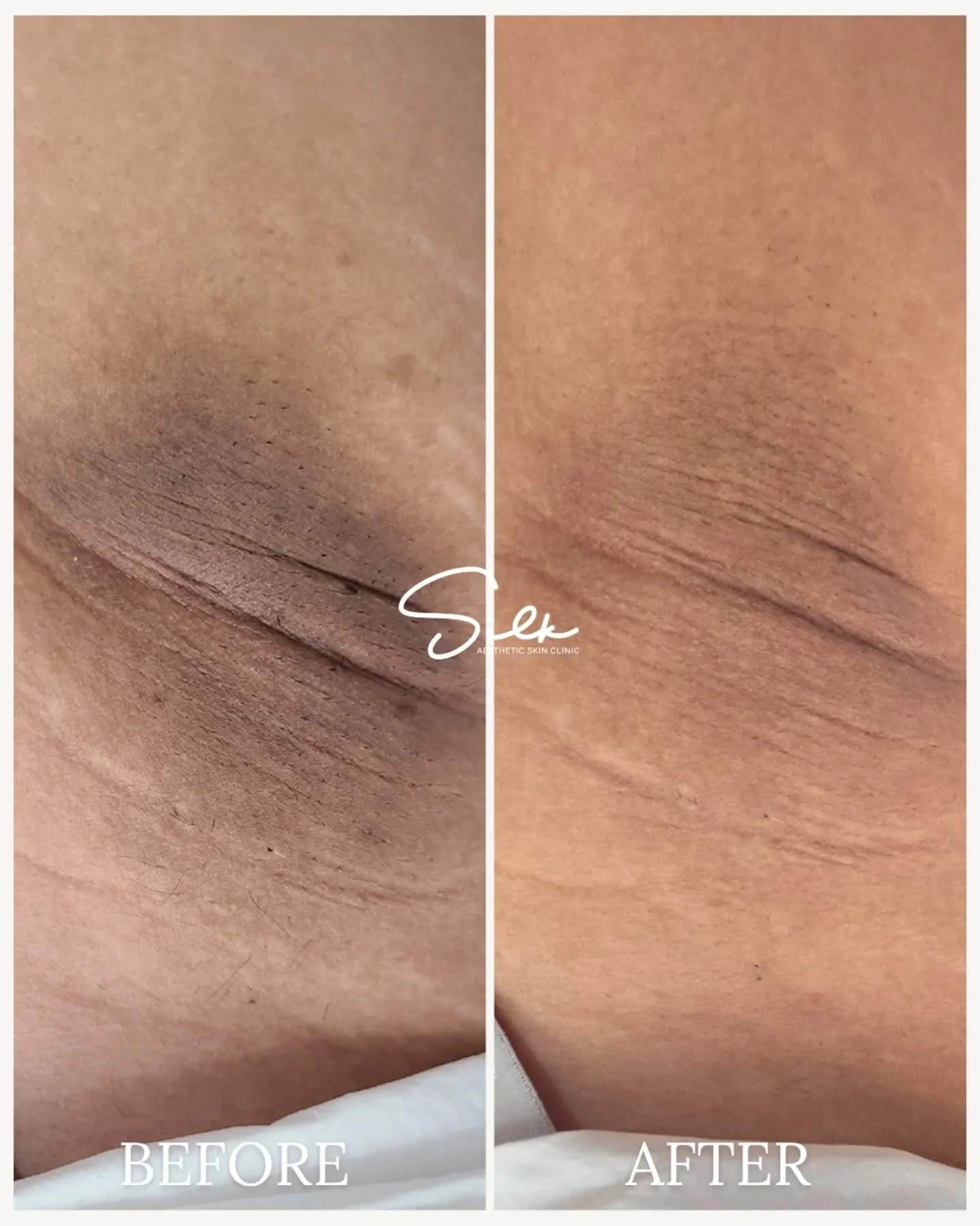 Brighten Up Your Underarms This Season 🌟 

Say goodbye to dark spots and hello to smooth, glowing underarms! Check out this incredible before and after of our Underarm Skin Lightening treatment. 

Ready for smoother, brighter skin? Book your appoint