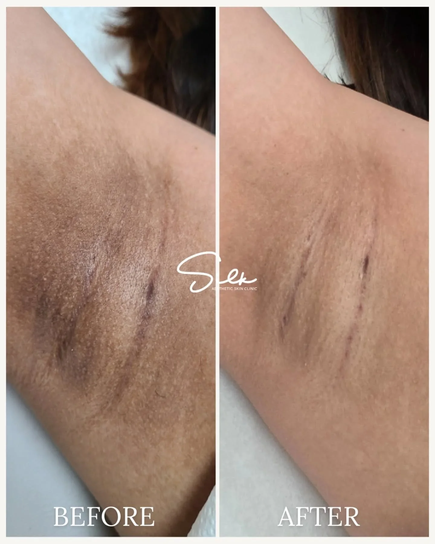 Winter is the perfect time to prep for your glowing underarms. ❄️✨ 

Look at these beautiful results from our Underarm Skin Lightening treatment! As the season slows down, it&rsquo;s the ideal moment to give your skin the attention it deserves for br