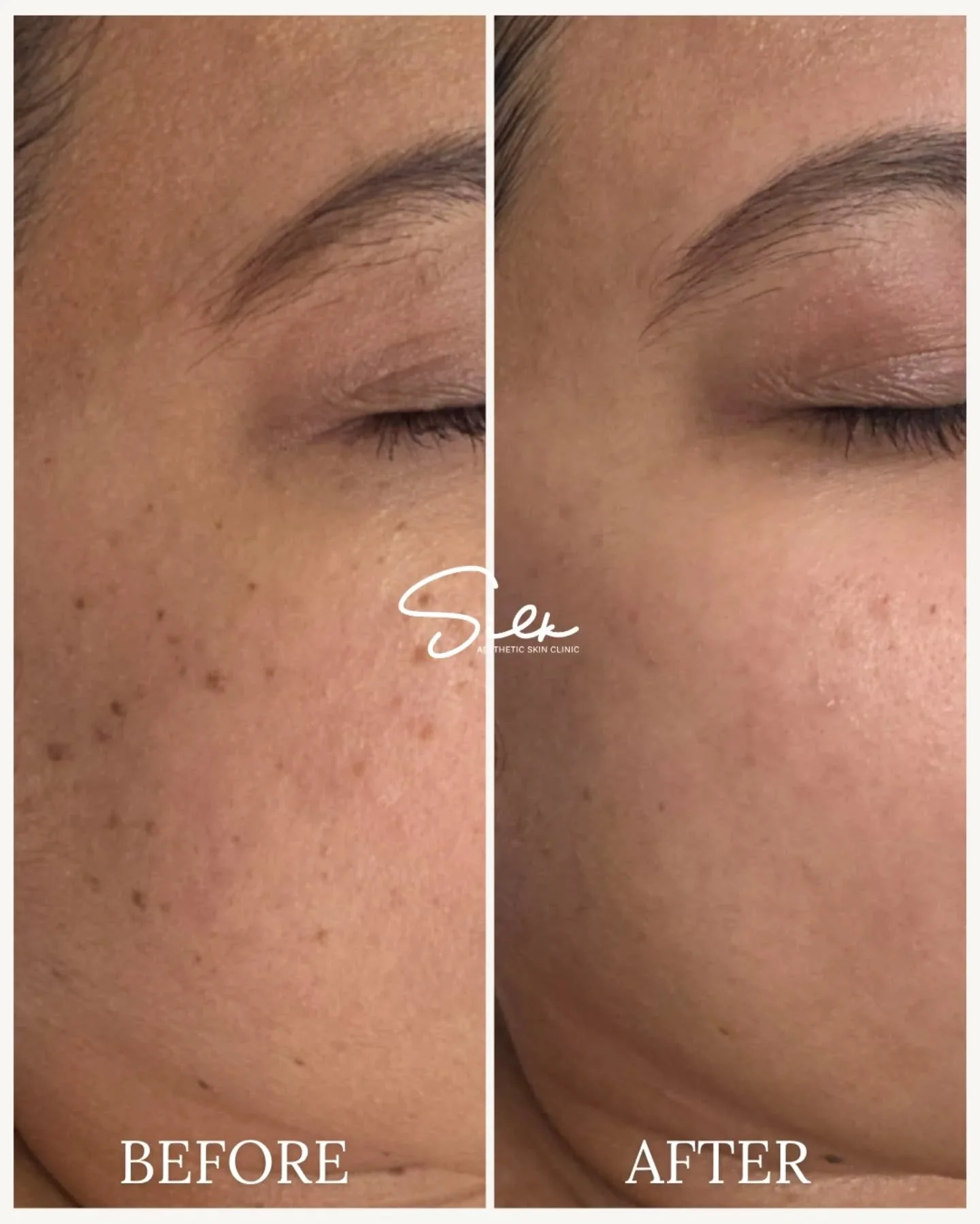 ❄️ Winter skin feeling a little lackluster? Give your skin the ultimate refresh with our Hollywood Laser Peel! 
From dull and uneven to smooth and radiant, this treatment works wonders to brighten and refresh your skin, just in time for the holidays.