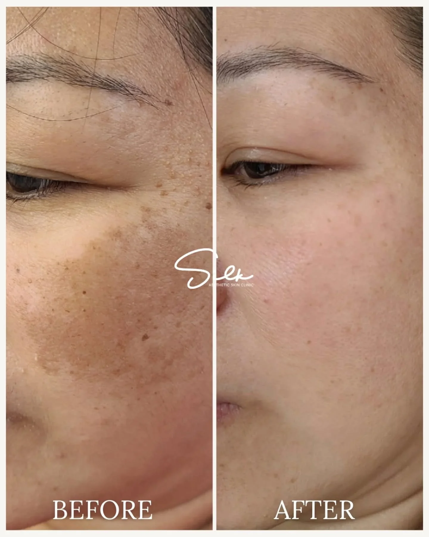 Melasma does not fade overnight. It fades with the right plan ✨ 

This before and after shows what happens when pigmentation is treated strategically, not aggressively. Melasma is complex and often driven by hormones, sun exposure, and inflammation, 