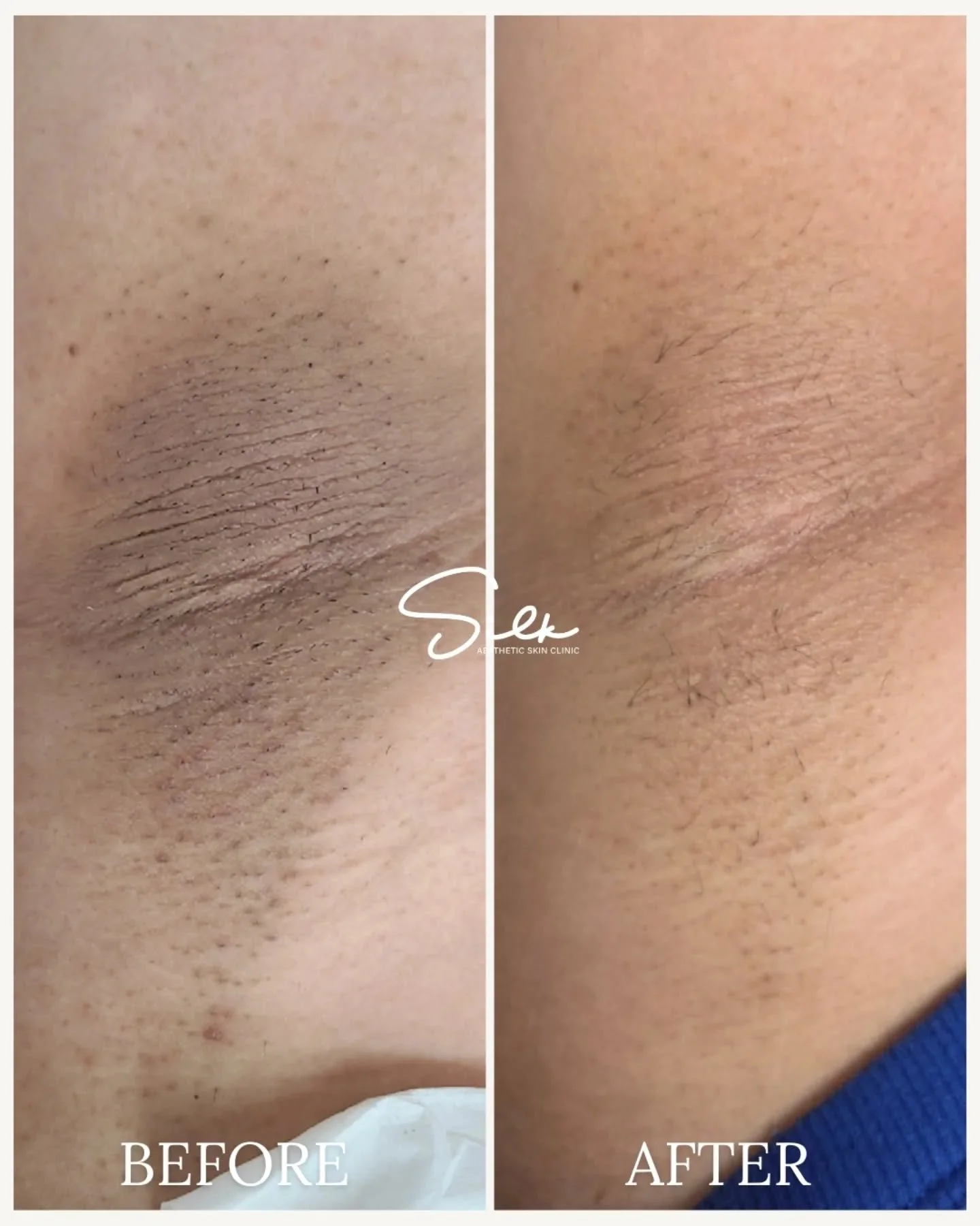 Love your skin in every detail this Valentine&rsquo;s Day 💕 

This underarm transformation didn&rsquo;t happen overnight. With a customized skin lightening plan, texture appears smoother, tone looks more even, and confidence shows through. 

Because