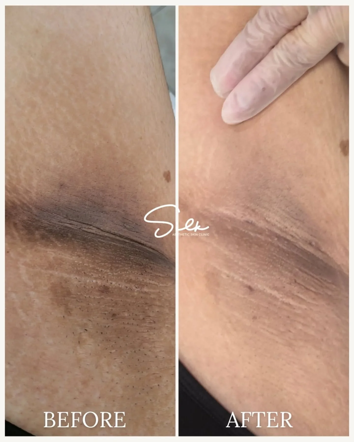 Dark underarms don&rsquo;t change overnight. Results come with the right plan. 💫 

This before and after shows what consistent underarm skin lightening can do. Over time, targeted treatments help reduce pigmentation, smooth texture, and restore a mo