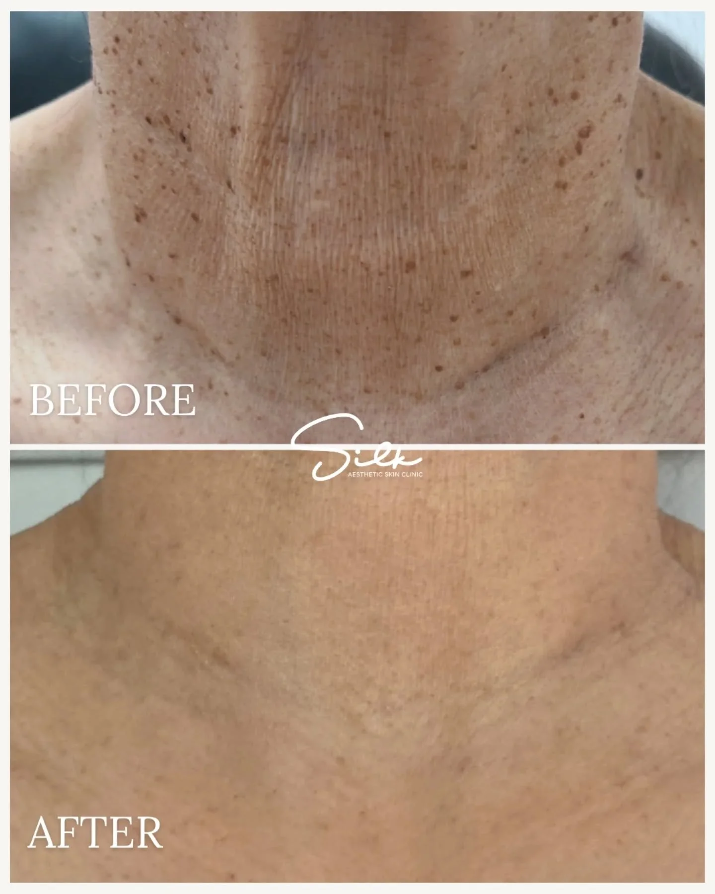 If your neck is giving away your age&hellip; this is your sign. ✨ 

Sun spots, pigmentation, and uneven texture don&rsquo;t just happen on the face. The neck is one of the first areas to show sun damage and collagen loss. 

This before and after show