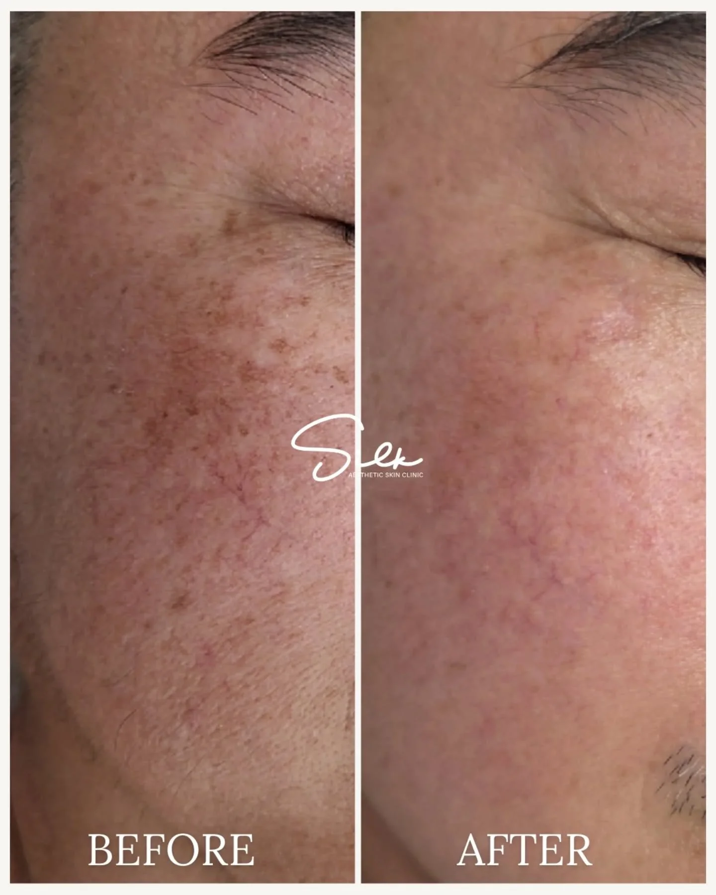 Sun damage and redness don&rsquo;t fade on their own. 🌟 

This before &amp; after shows visible improvement in pigmentation, uneven tone, and broken capillaries with targeted, professional treatment. 

If you&rsquo;re tired of covering it up with ma