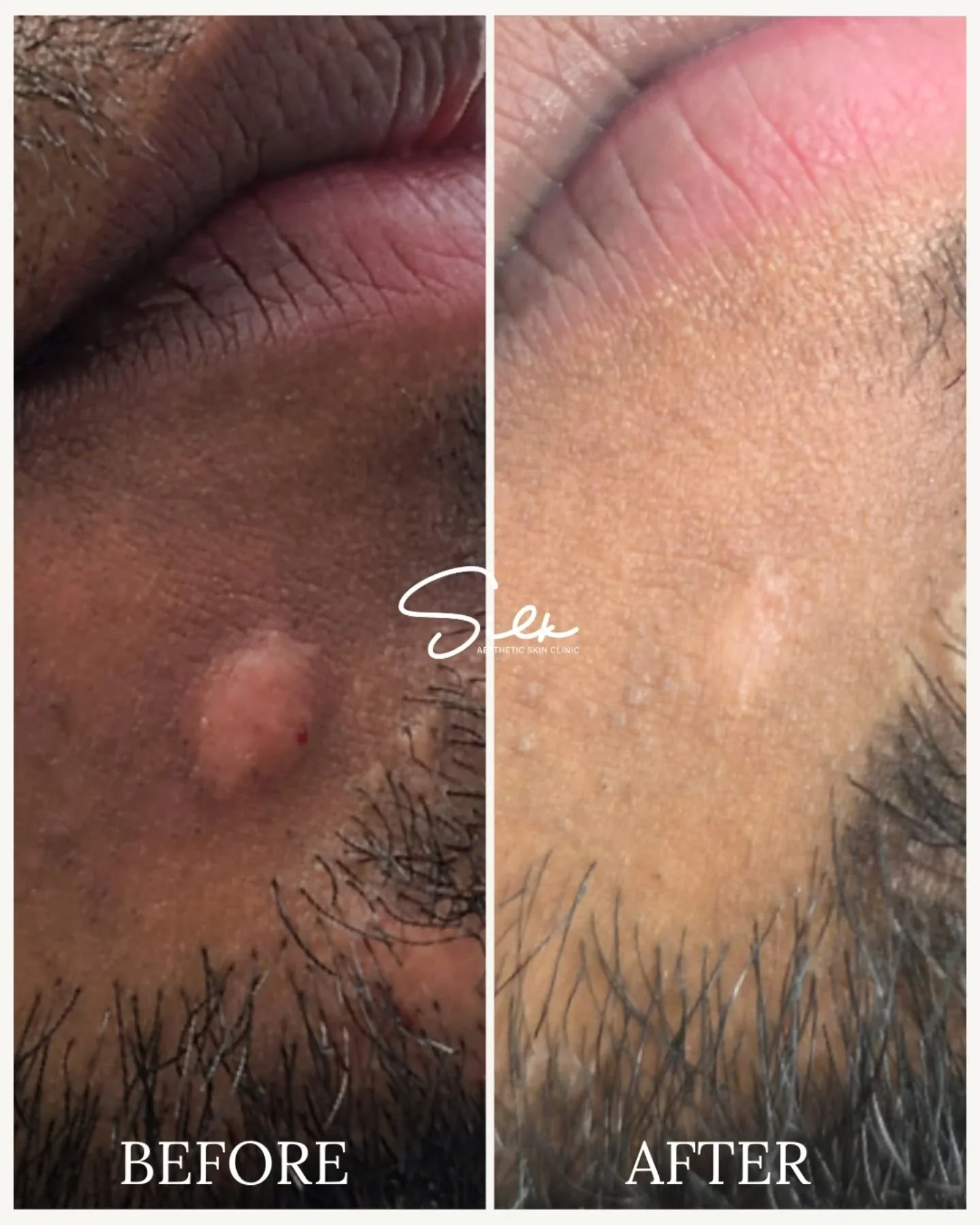 That painful, stubborn bump? It needed more than skincare. 💫 

This isn&rsquo;t just skincare. It&rsquo;s targeted, in-clinic acne treatment designed to calm inflammation, flatten cystic bumps, and support proper healing without scarring. 

If your 