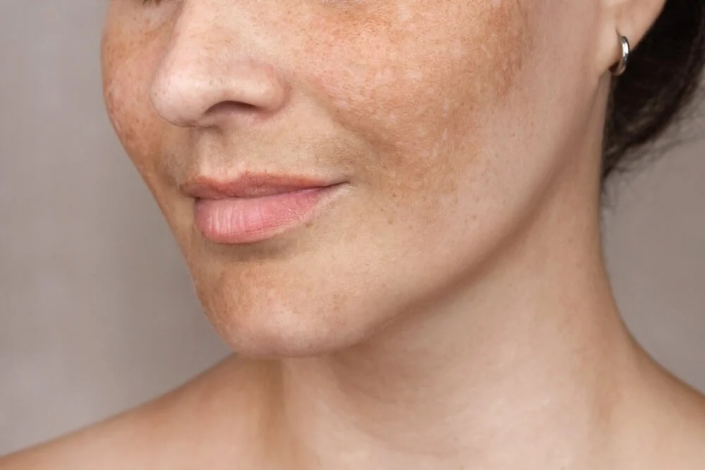 Why Melasma Is More Than Just a Dark Spot