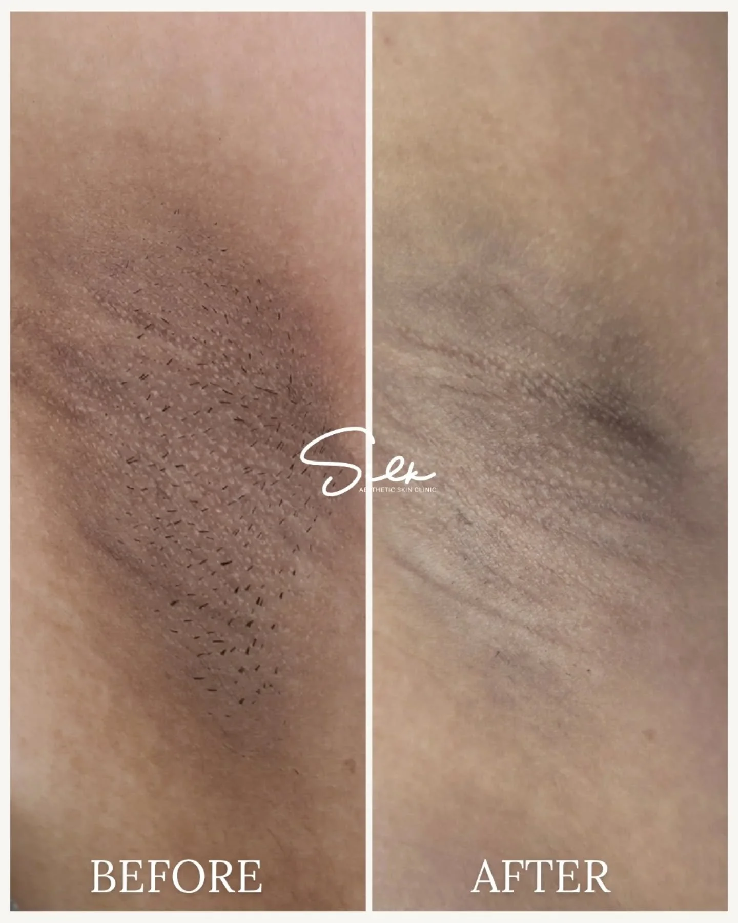 Dark underarms are common&hellip; but they&rsquo;re not permanent. 💫 

This before &amp; after shows visible improvement in pigmentation and uneven texture with professional underarm brightening treatment. 

Smoother. Brighter. More even tone. 

Sha