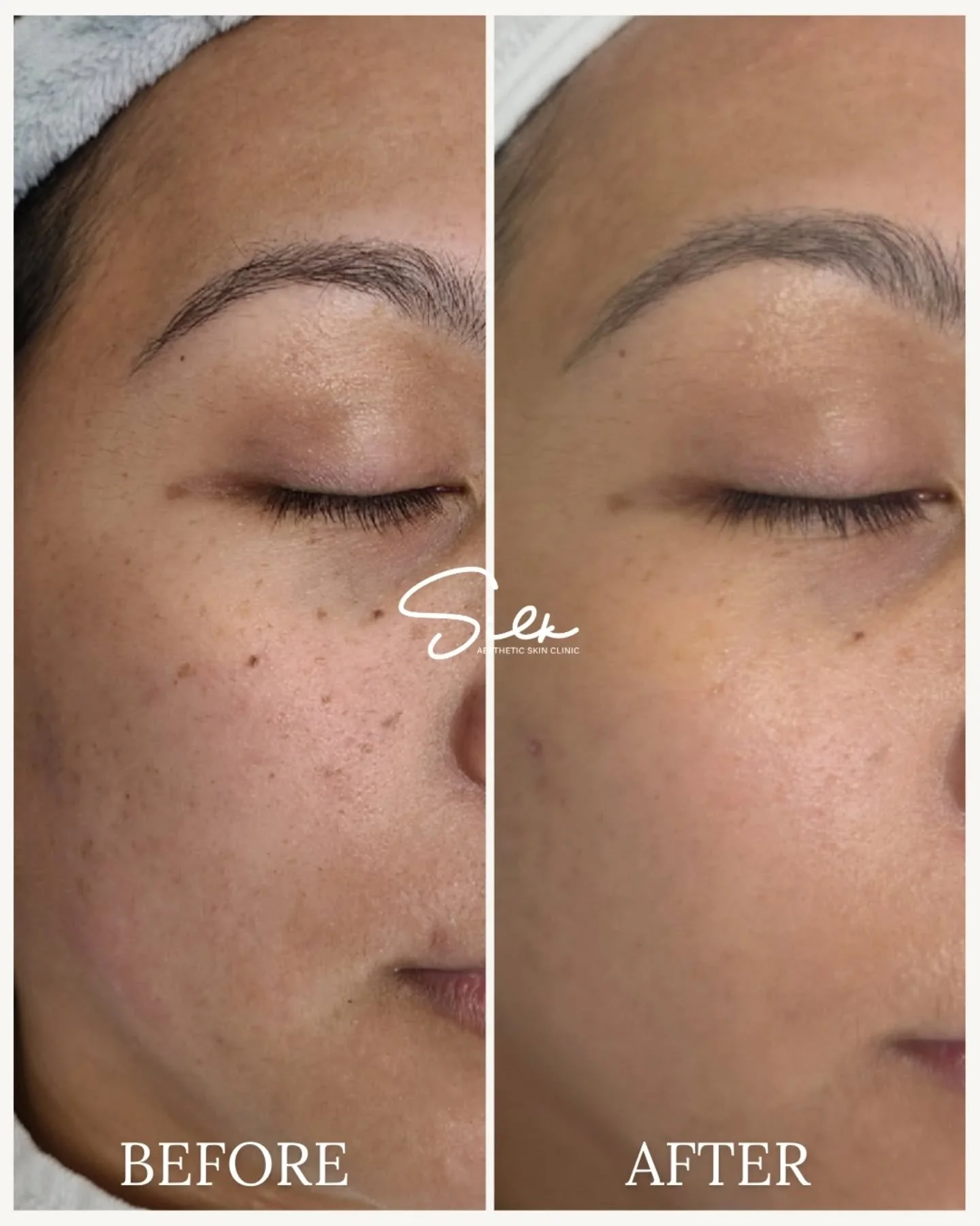 Melasma doesn&rsquo;t fade on its own but it can be managed beautifully. 🌟

This before &amp; after shows visible improvement in stubborn pigmentation and overall skin clarity through a customized melasma treatment plan.

Melasma is triggered by sun