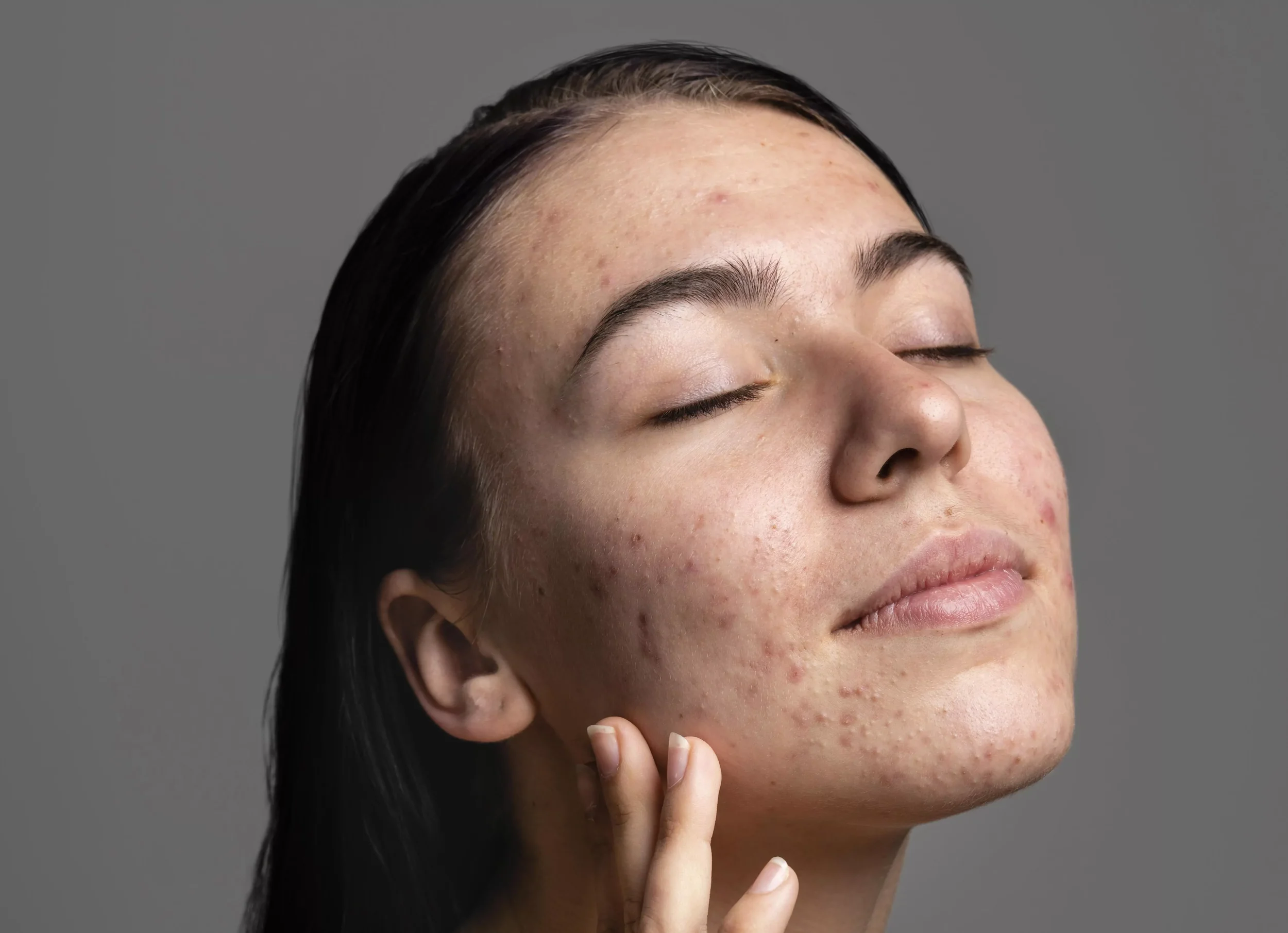 7 Essential Habits for Acne-Prone Skin