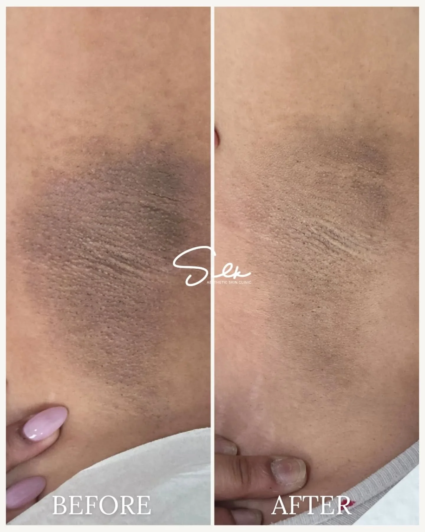 This is your sign to stop settling for dark underarms. ✨

This before &amp; after shows visible improvement in pigmentation and texture with professional underarm skin lightening treatment.

Underarm discoloration can be caused by shaving, friction, 