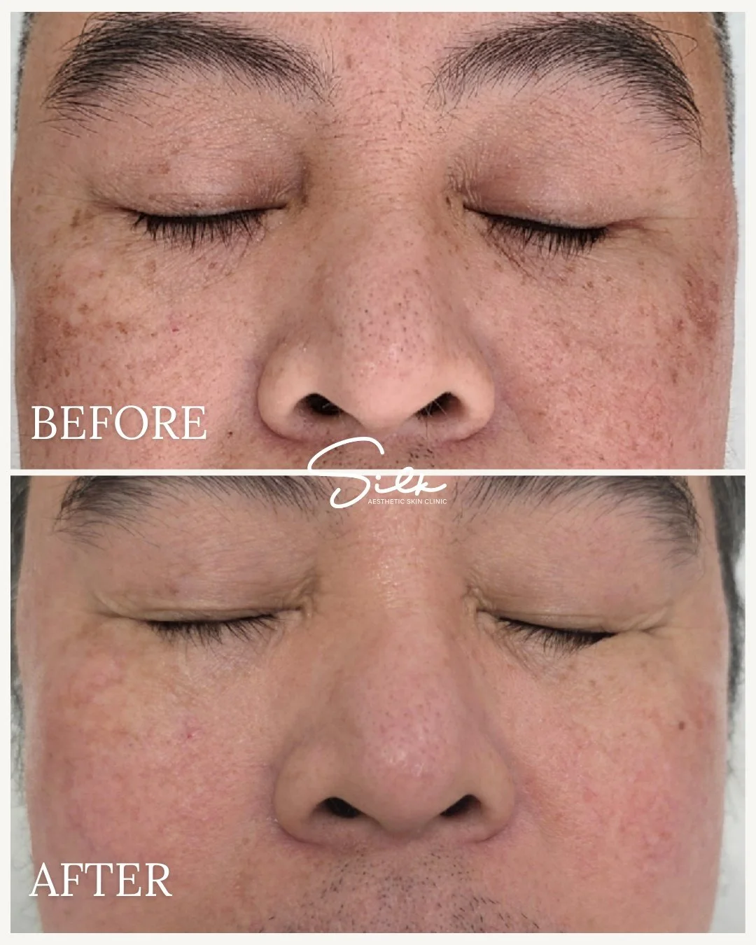 Melasma is stubborn. But it&rsquo;s not untreatable. ✨

This before &amp; after shows visible improvement in pigmentation and overall skin clarity with a customized melasma treatment plan.

Melasma is triggered by sun, heat, and hormones, which means