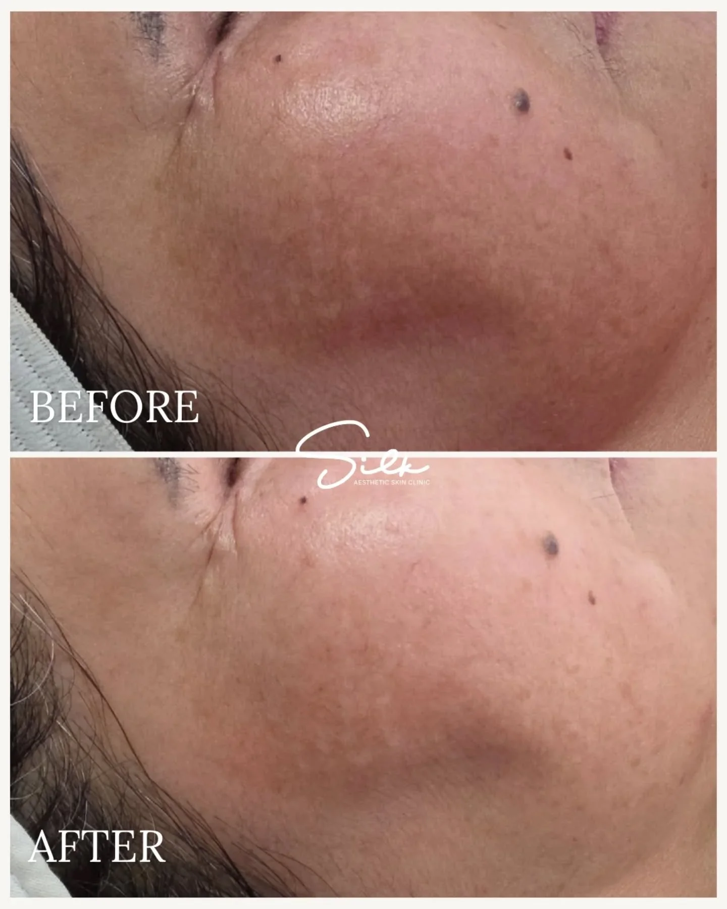 Melasma doesn&rsquo;t fade on its own. ✨ 

This before &amp; after shows visible improvement in stubborn pigmentation with a customized melasma treatment plan. 

Melasma is triggered by sun, heat, and hormones, and it needs more than just brightening