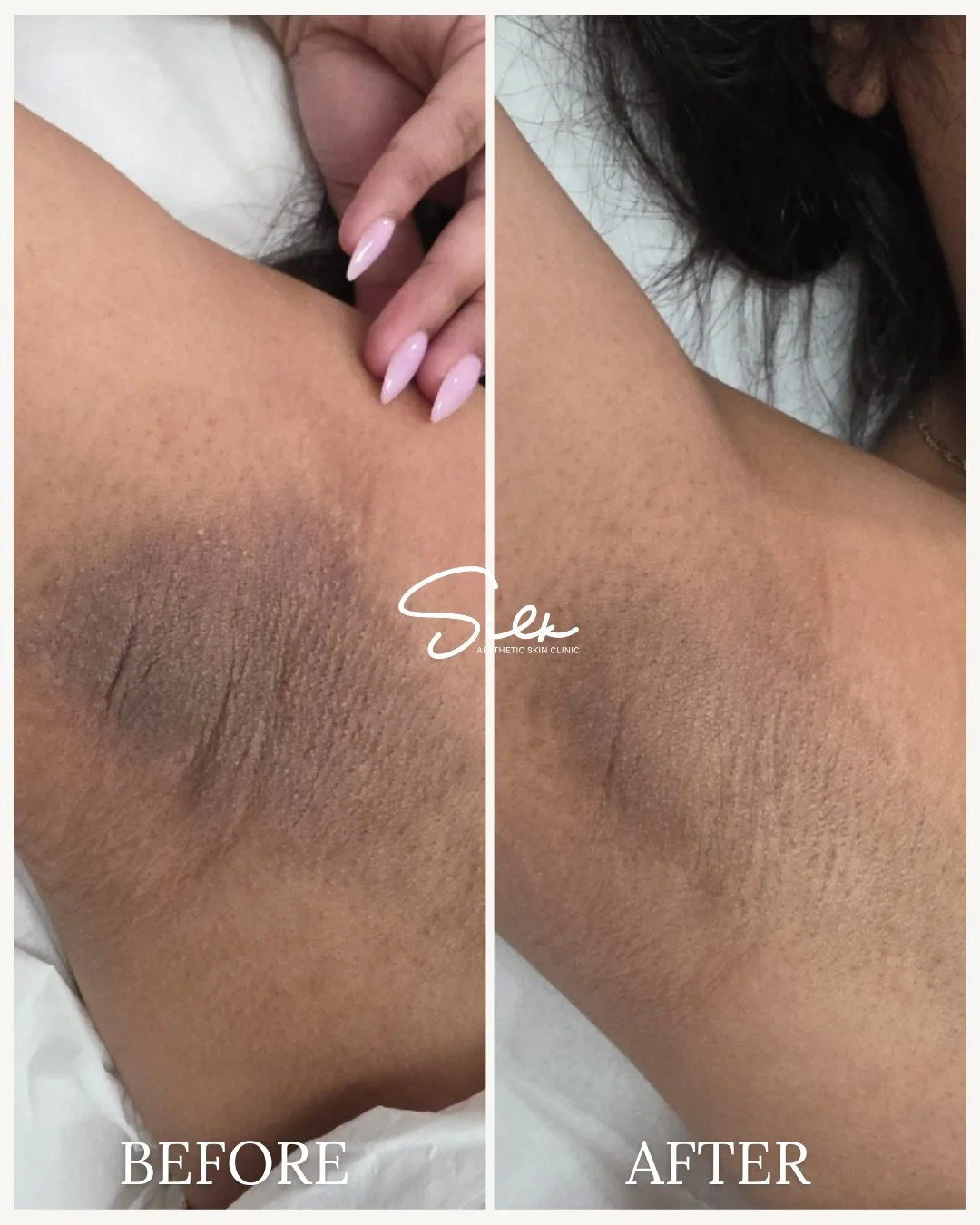 Dark underarms can happen for many reasons, but the right treatment can help improve the appearance of uneven tone.

This before and after shows how targeted treatments can help lighten pigmentation, smooth texture, and support healthier-looking skin