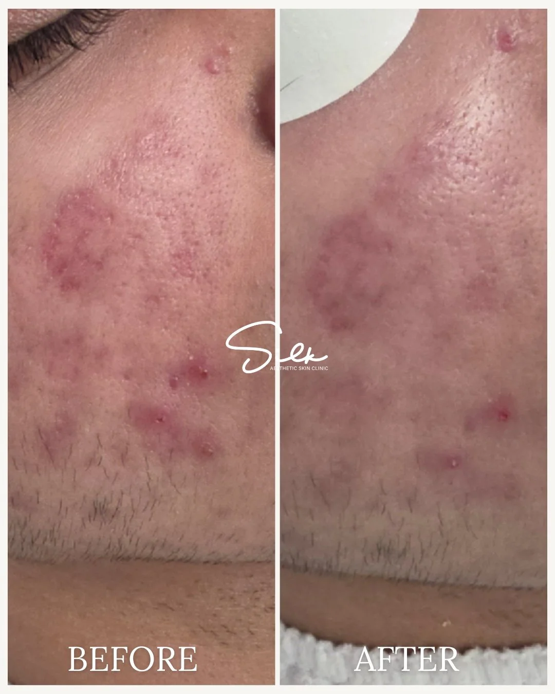 Acne is more than just breakouts. It can affect texture, redness, and overall skin health.

This before and after shows how targeted treatments and consistent care can help calm inflammation, improve skin texture, and support clearer-looking skin ove