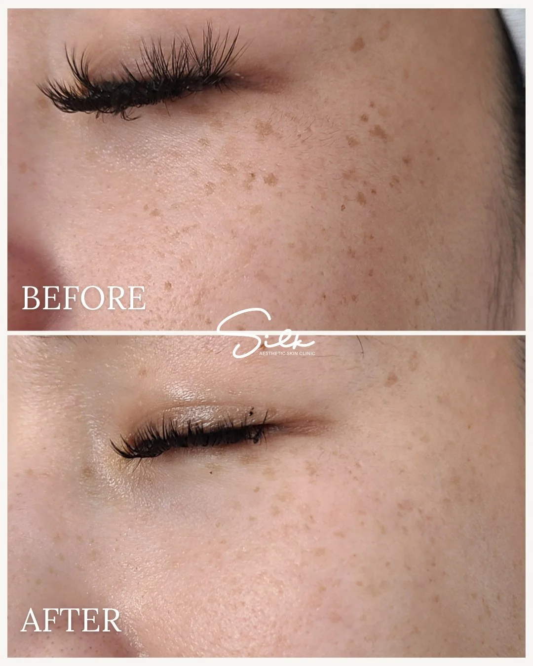 Those small brown spots don&rsquo;t have to stay.

This before and after shows how targeted treatments can help reduce the appearance of pigmentation and uneven tone, revealing brighter and smoother-looking skin over time.

Healthy skin is not about 