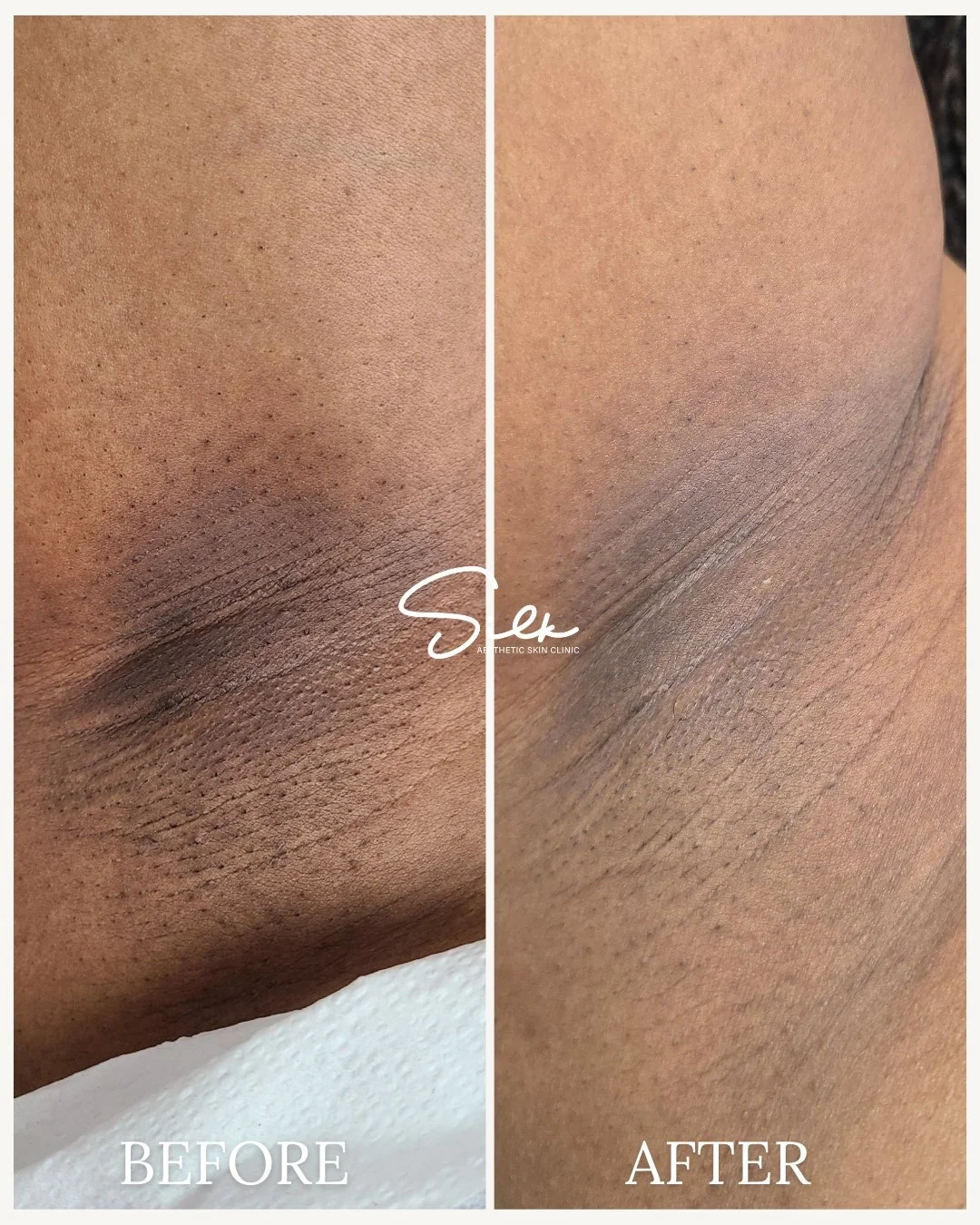 Dark underarms are more common than you think.

Pigmentation in this area can be caused by friction, shaving, and buildup over time. With the right treatments and consistent care, the appearance of uneven tone and texture can gradually improve.

This