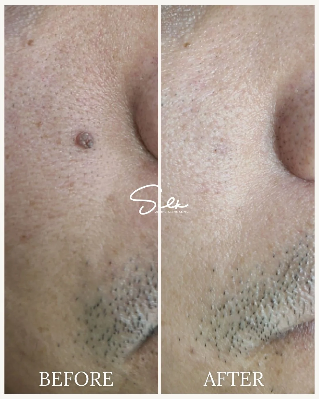 Small skin growths like this can be safely treated.

Skin tags or benign skin growths are common and can appear on different areas of the face and body. With the right treatment, they can be removed with minimal downtime while keeping the surrounding