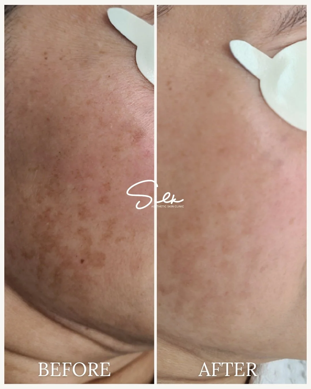 Melasma doesn&rsquo;t fade overnight&hellip; but it can be improved.

This before and after shows how consistent, targeted treatments can help reduce the appearance of melasma and uneven pigmentation over time.

With the right approach, skin can look